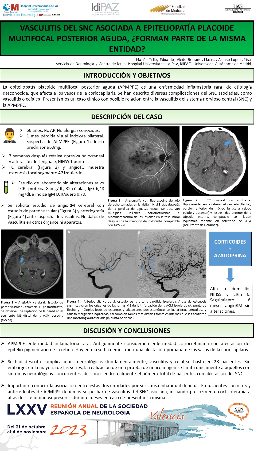 Vasculitis del SNC en relación a epiteliopatía placoide multifocal posterior aguda, ¿Forman parte de la misma entidad?