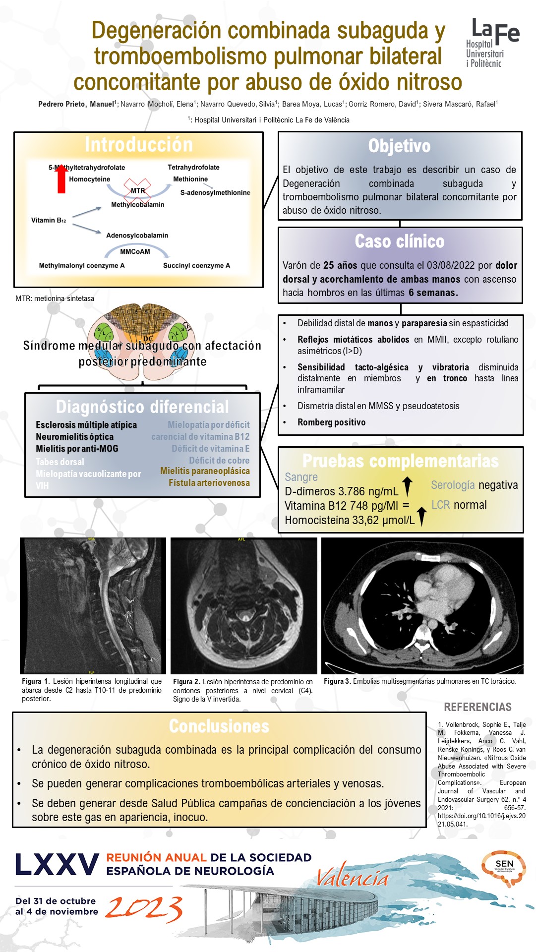 Degeneración combinada subaguda y tromboembolismo pulmonar bilateral concomitante por abuso de óxido nitroso