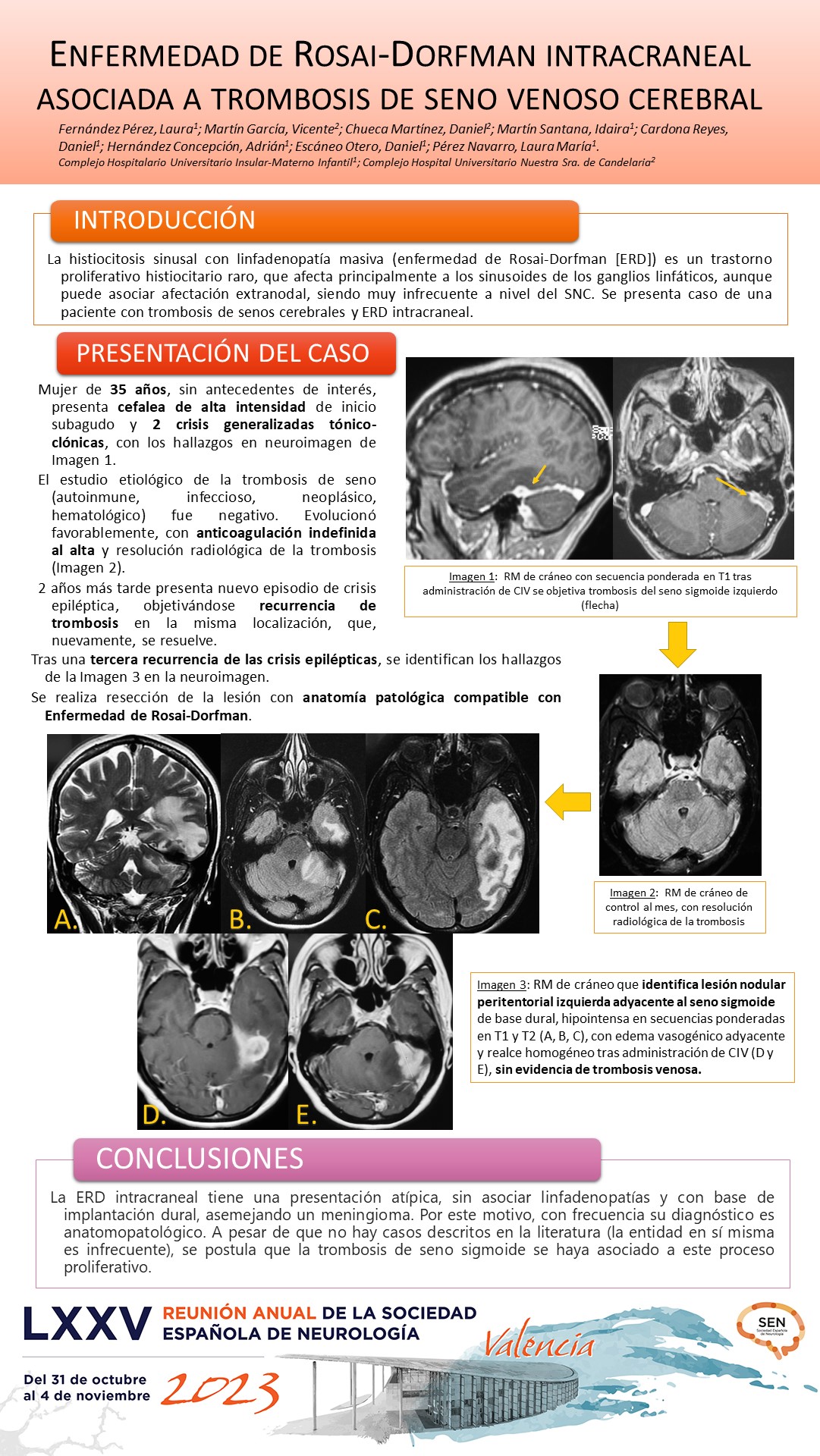 Enfermedad de Rosai-Dorfman intracraneal asociada a trombosis de seno venoso cerebral