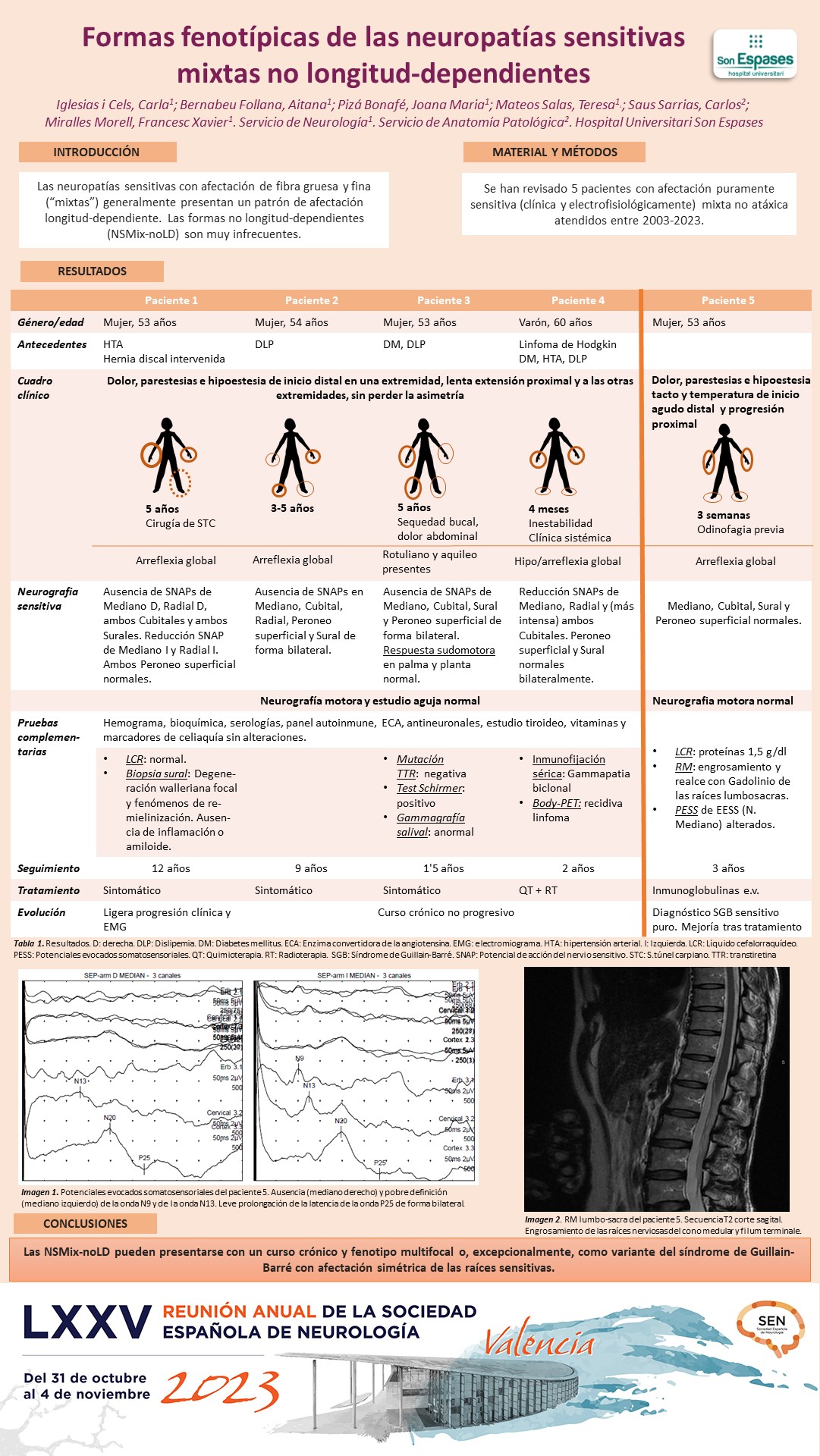 Formas fenotípicas de las neuropatías sensitivas mixtas no longitud-dependientes