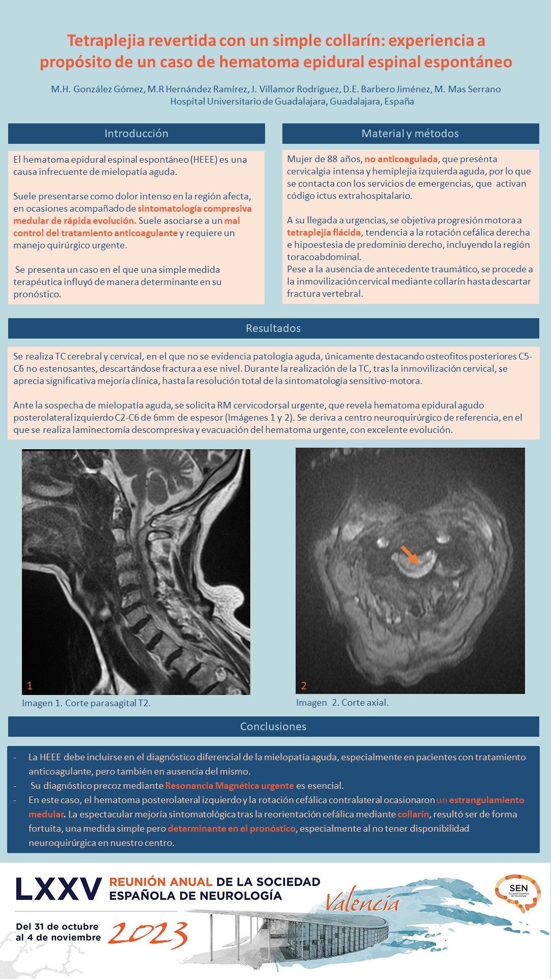 Tetraplejia revertida con un simple collarín: experiencia a propósito de un caso de hematoma epidural espinal espontáneo