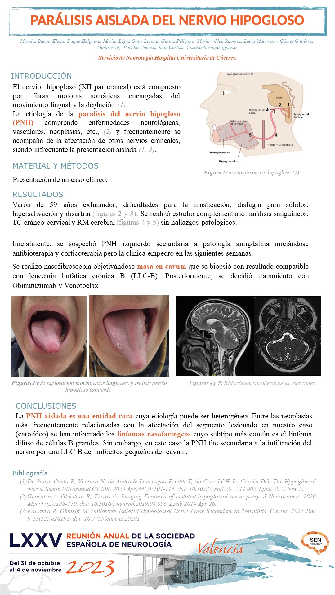 Parálisis aislada del nervio hipogloso