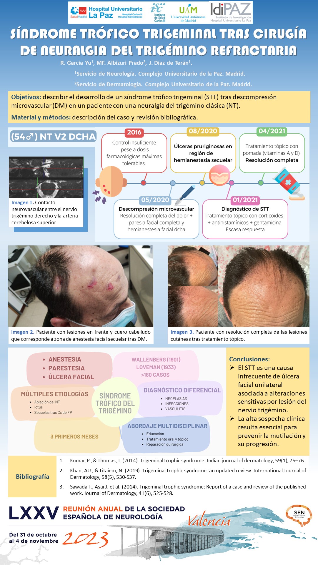 Síndrome trófico trigeminal tras cirugía de neuralgia del trigémino refractaria