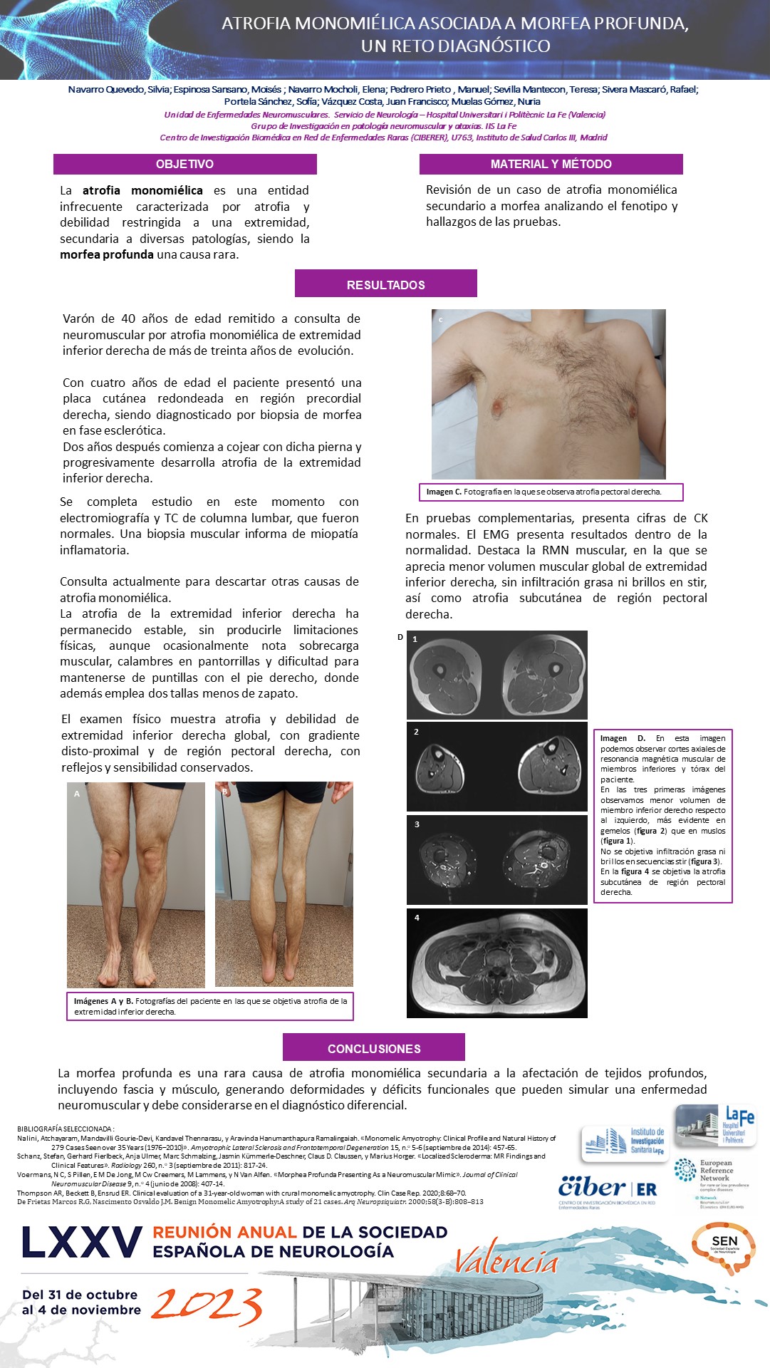 Atrofia monomiélica asociada a morfea profunda, un reto diagnóstico