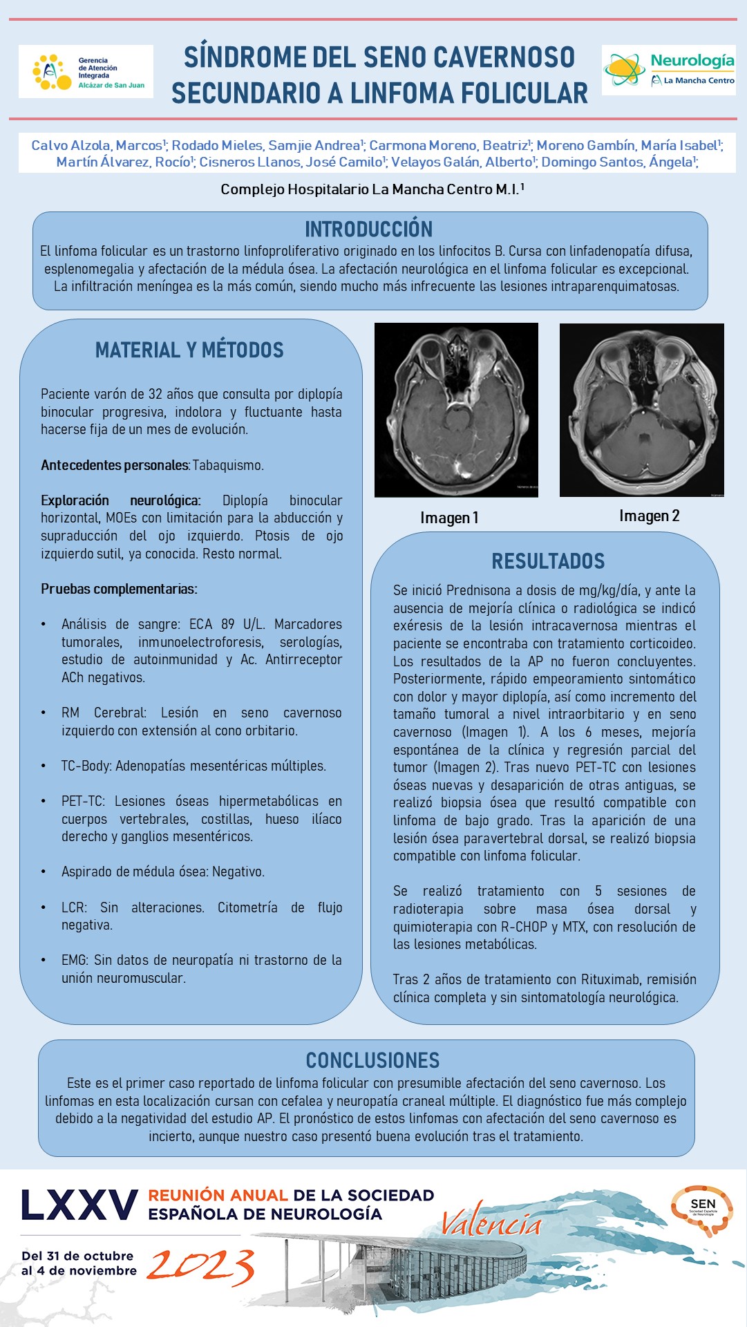 Síndrome del seno cavernoso secundario a linforma folicular