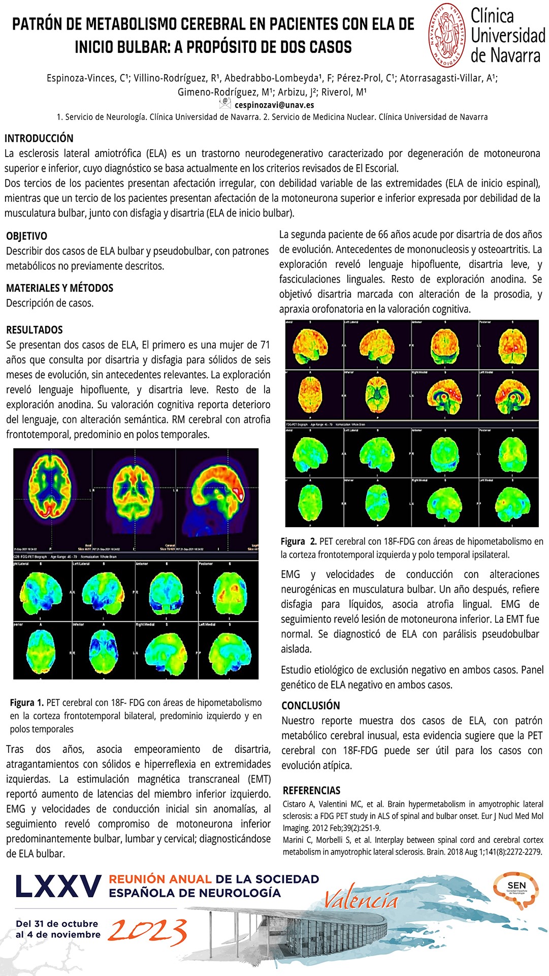 Patrón de metabolismo cerebral en pacientes con ELA de inicio bulbar: a propósito de dos casos