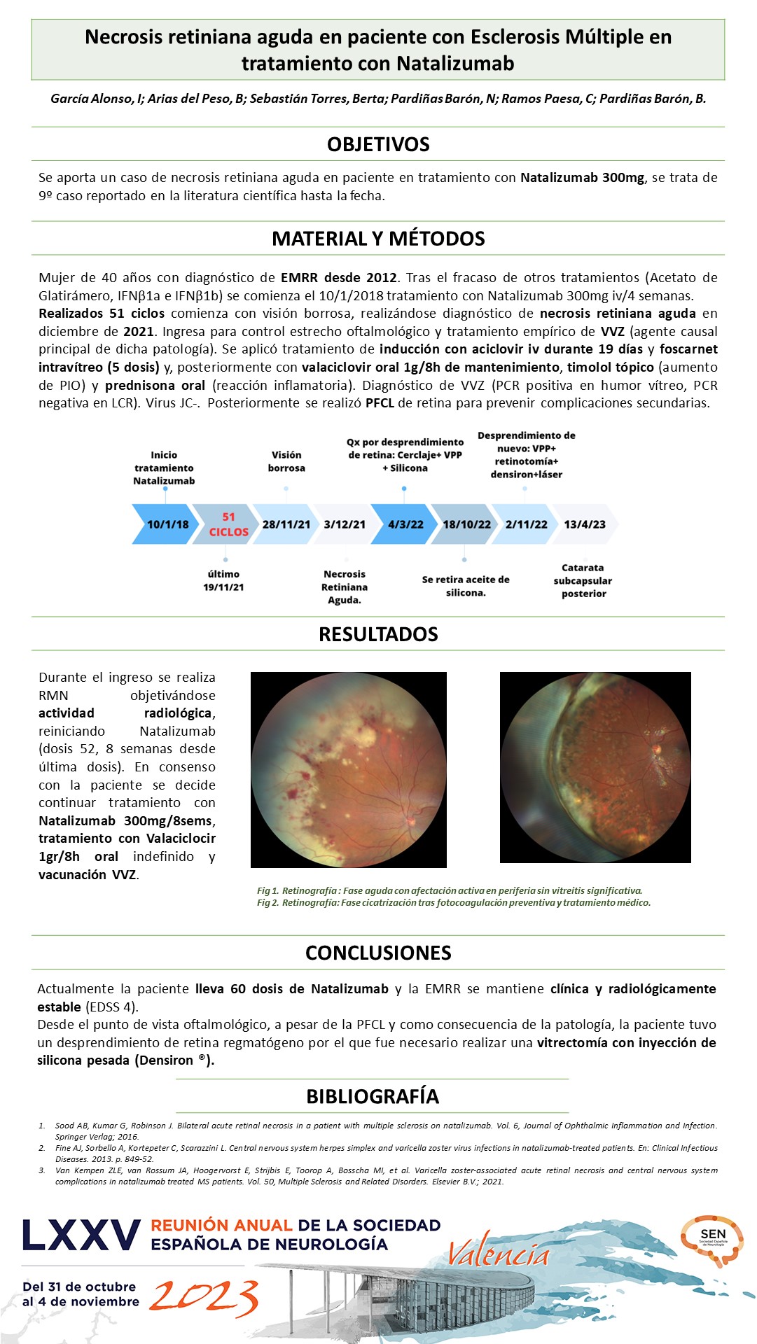 Necrosis retiniana aguda en paciente con Esclerosis Múltiple en tratamiento con Natalizumab