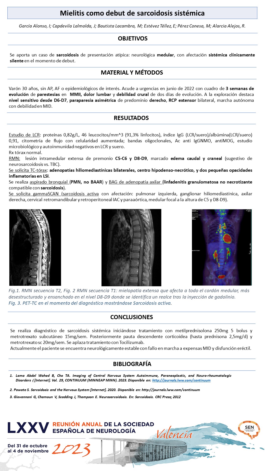 Mielitis como debut de sarcoidosis sistémica