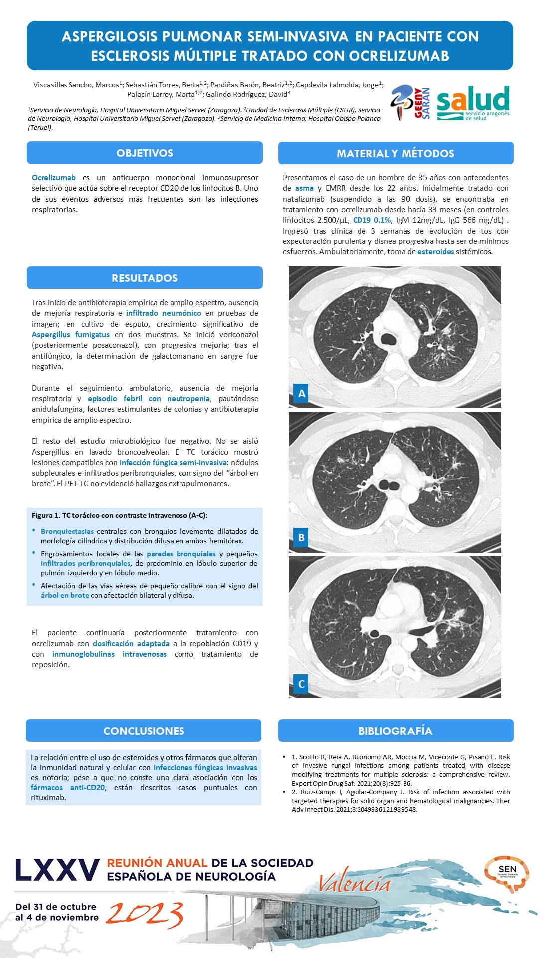 Aspergilosis pulmonar semi-invasiva en paciente con esclerosis múltiple tratado con ocrelizumab