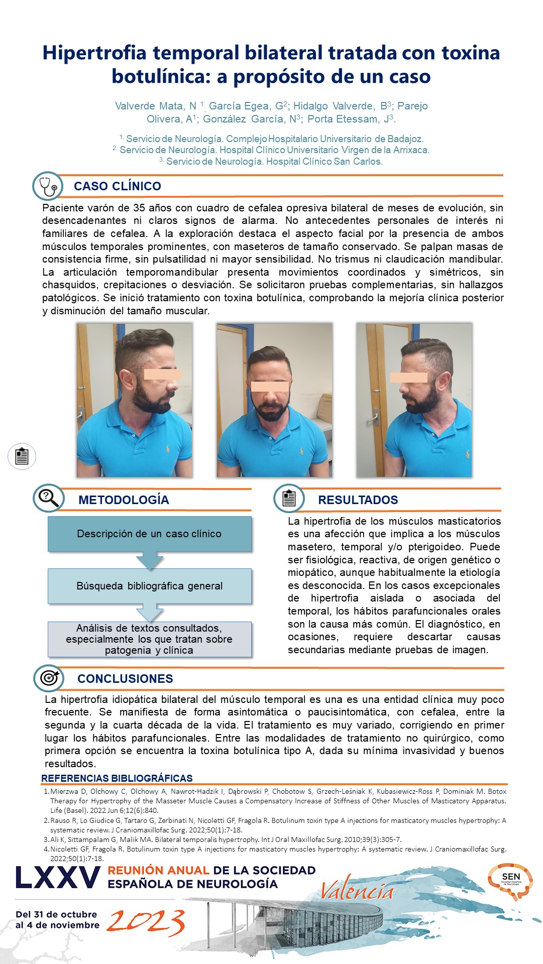 Hipertrofia temporal bilateral tratada con toxina botulínica: a propósito de un caso