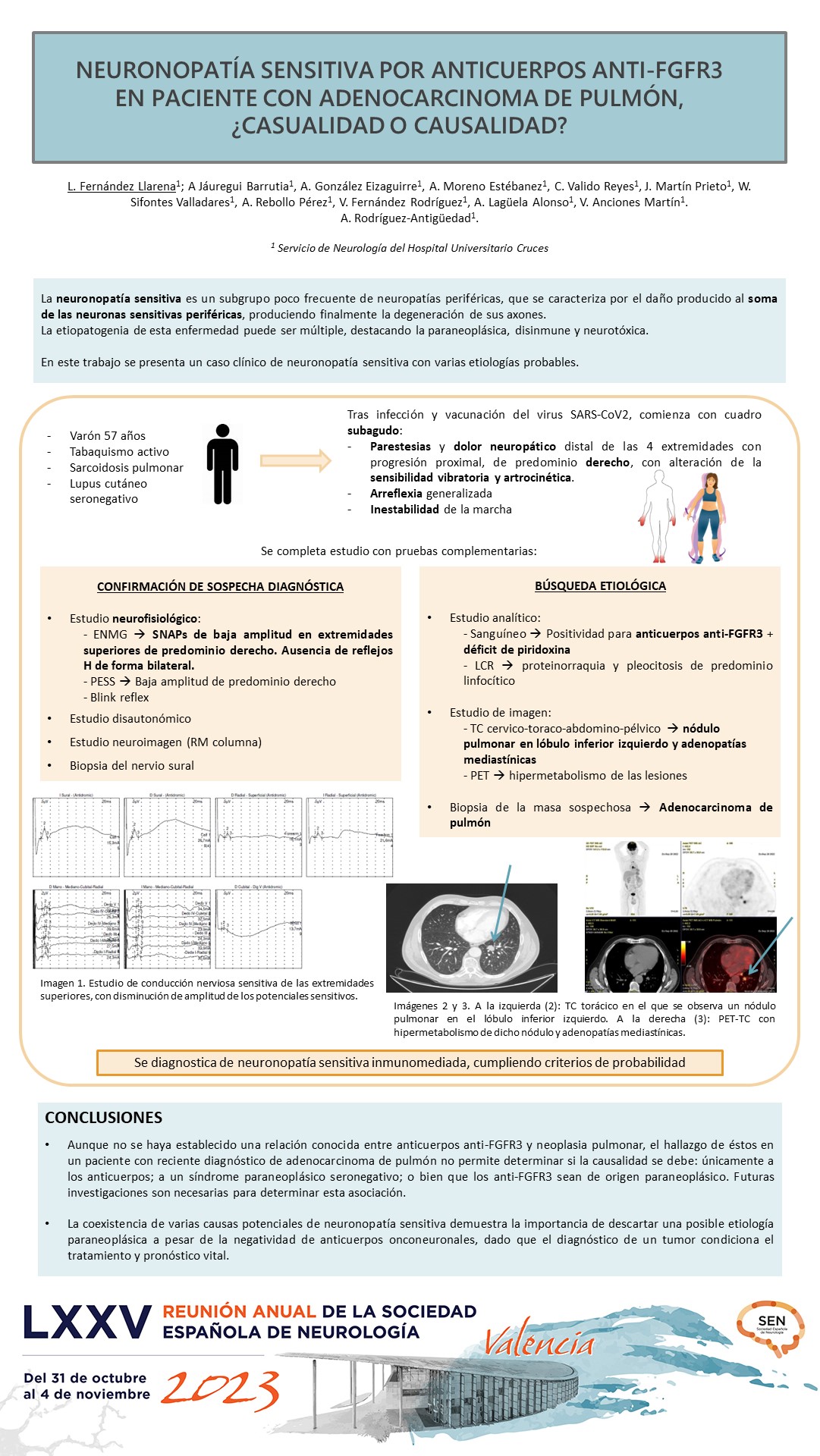 Neuronopatía sensitiva por anticuerpos anti-FGFR3 en paciente con adenocarcinoma de pulmón, ¿casualidad o causalidad?