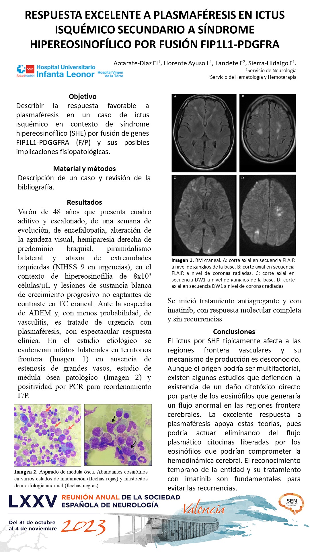Respuesta excelente a plasmaféresis en ictus isquémico secundario a síndrome hipereosinofílico por fusión FIP1L1-PDGFRA