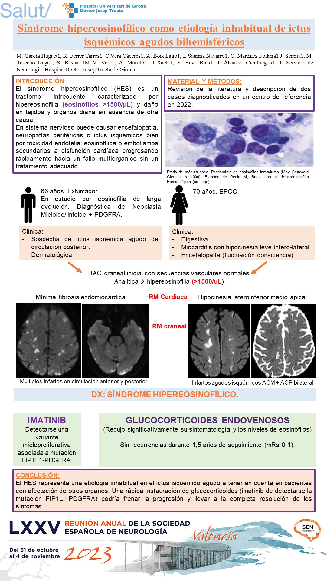 Síndrome hipereosinofílico como etiología inhabitual de ictus isquémicos agudos bihemisféricos