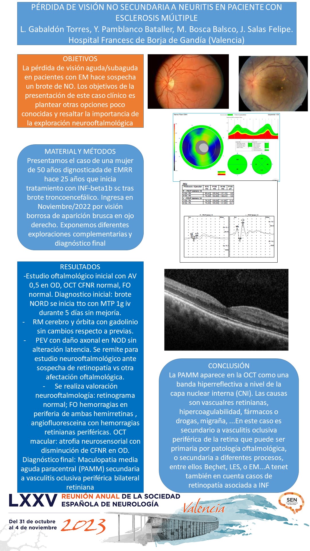 Pérdida de visión no secundaria a neuritis en paciente con esclerosis múltiple