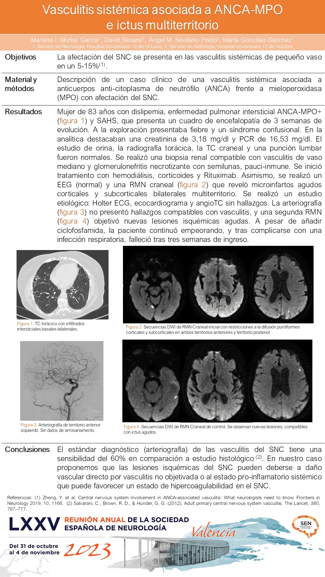 Vasculitis sistémica asociada a ANCA-MPO e ictus multiterritorio