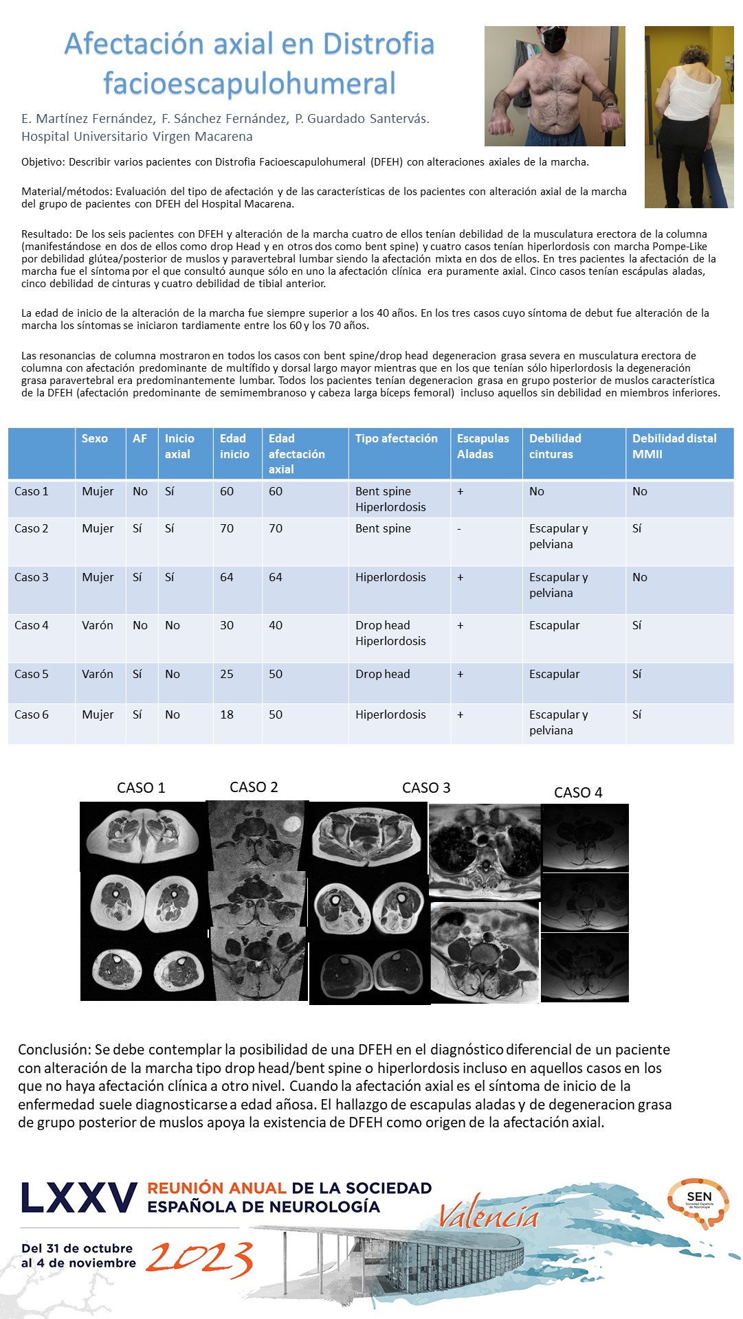 Afectación axial en Distrofia Facioescapulohumeral