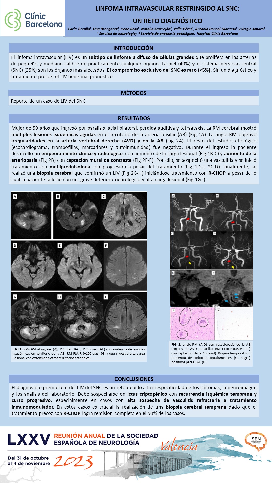 Linfoma intravascular restringido al SNC: un reto diagnóstico
