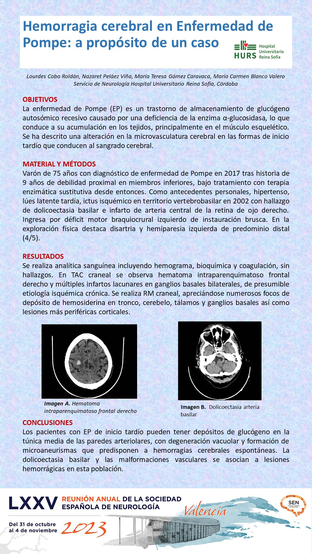 Hemorragia cerebral en Enfermedad de Pompe: a propósito de un caso 