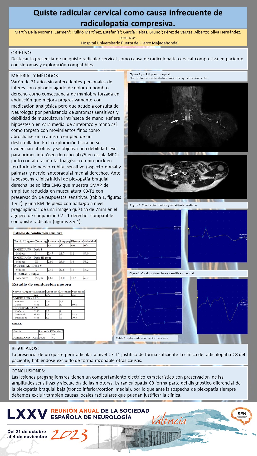 Quiste radicular cervical como causa infrecuente de plexopatía braquial compresiva. 