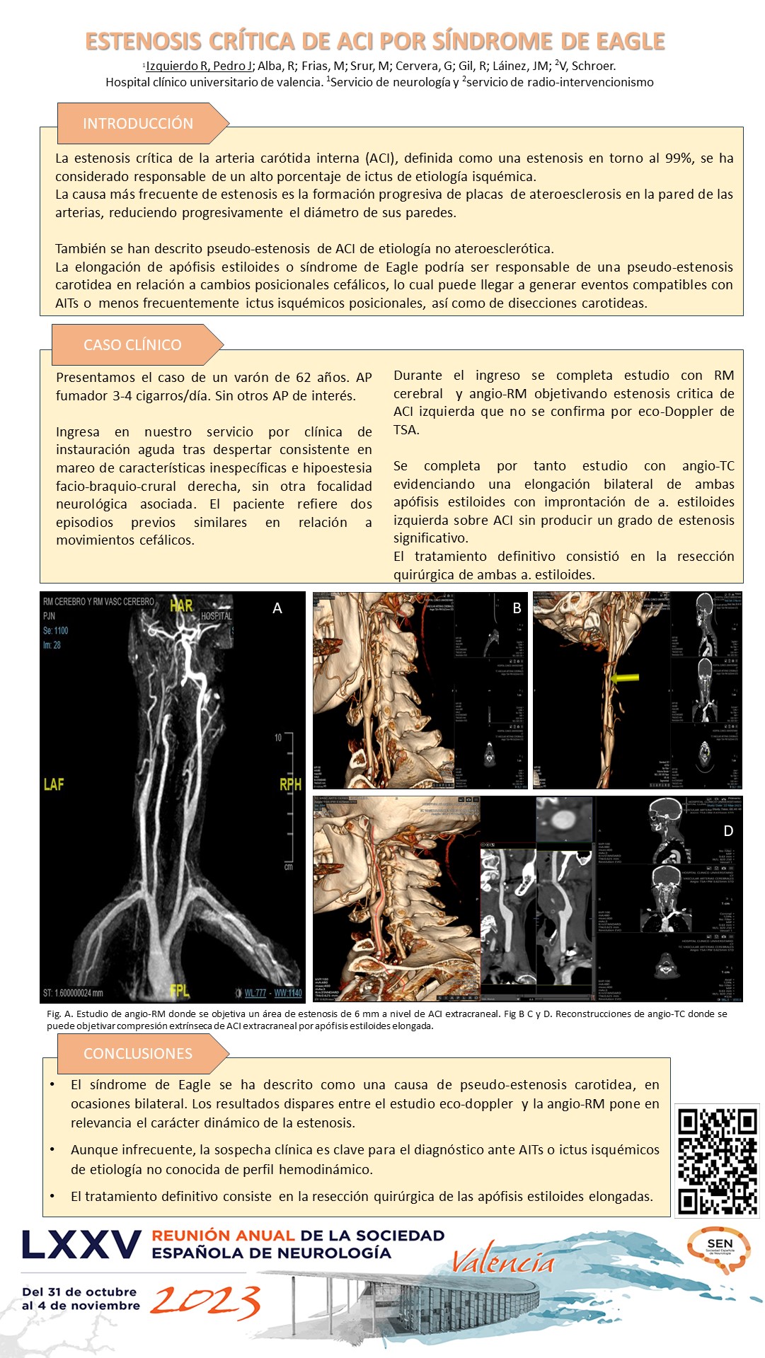 Estenosis crítica de ACI por elongación de apófisis estiloides (Síndrome de Eagle)