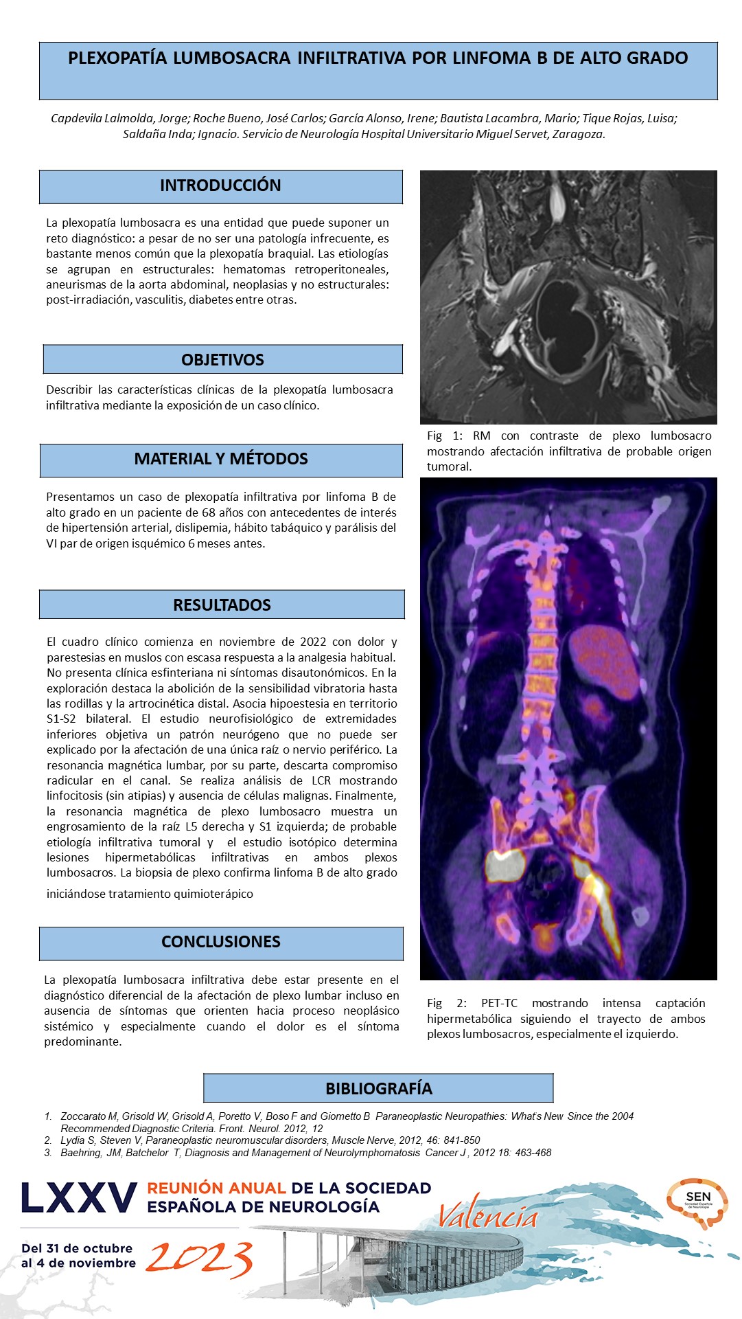 Plexopatía lumbosacra infiltrativa por linfoma b de alto grado