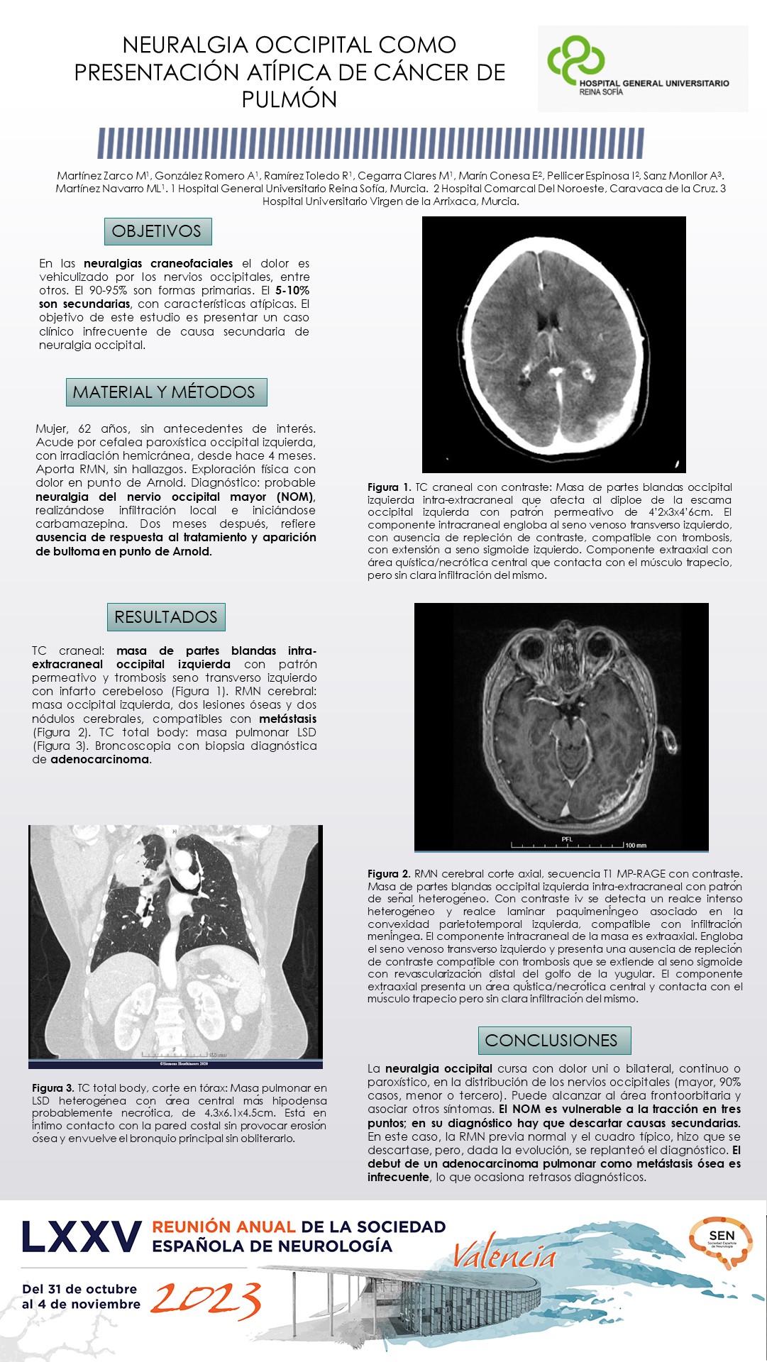 Neuralgia occipital como presentación atípica de cáncer de pulmón. 