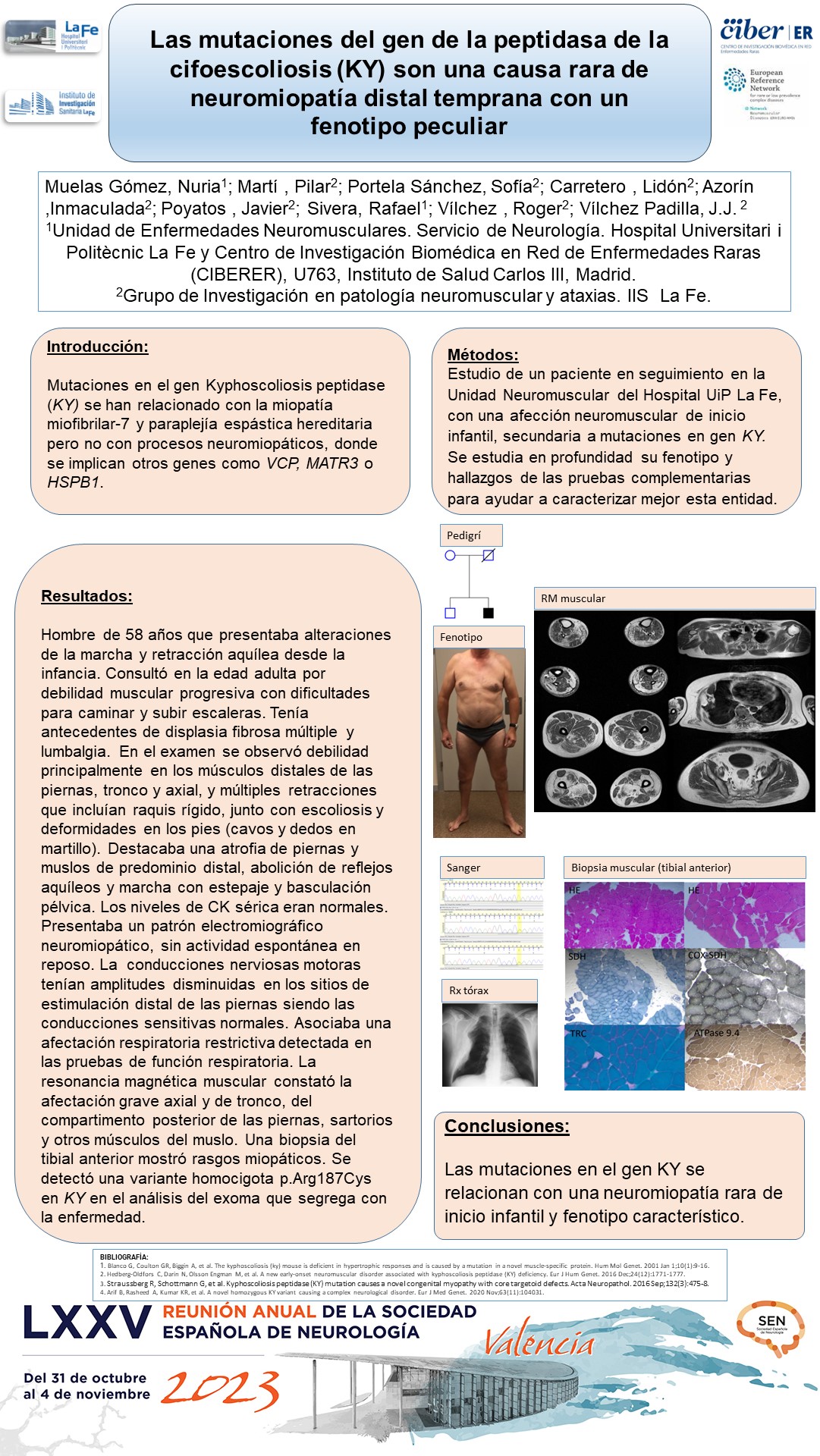 Las mutaciones del gen de la peptidasa de la cifoescoliosis (KY) son una causa rara de neuromiopatía distal temprana y con un fenotipo peculiar
