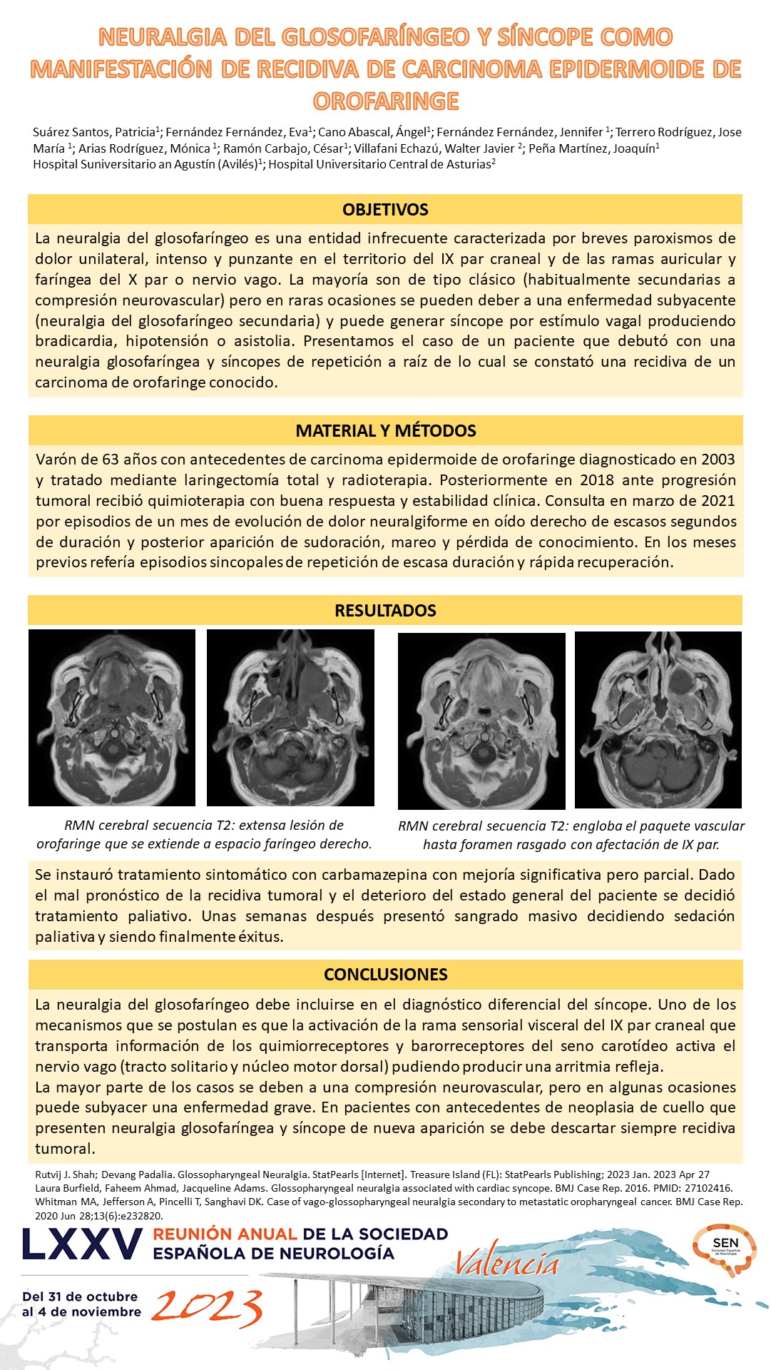 Neuralgia del glosofaríngeo y síncope como manifestación de recidiva de carcinoma epidermoide de orofaringe