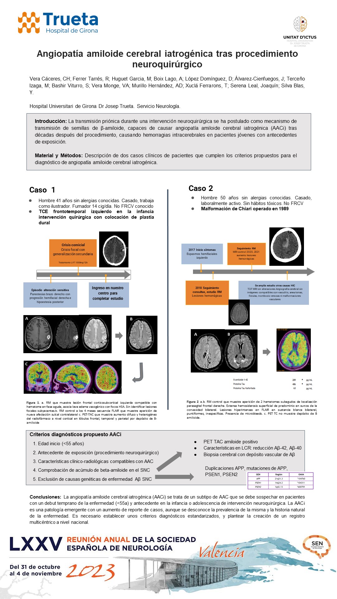 Angiopatía amiloide cerebral iatrogénica tras procedimiento neuroquirúrgico