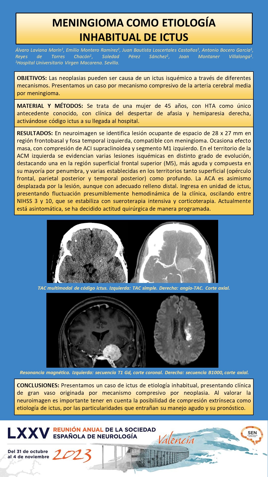 Meningioma como etiología habitual de ictus