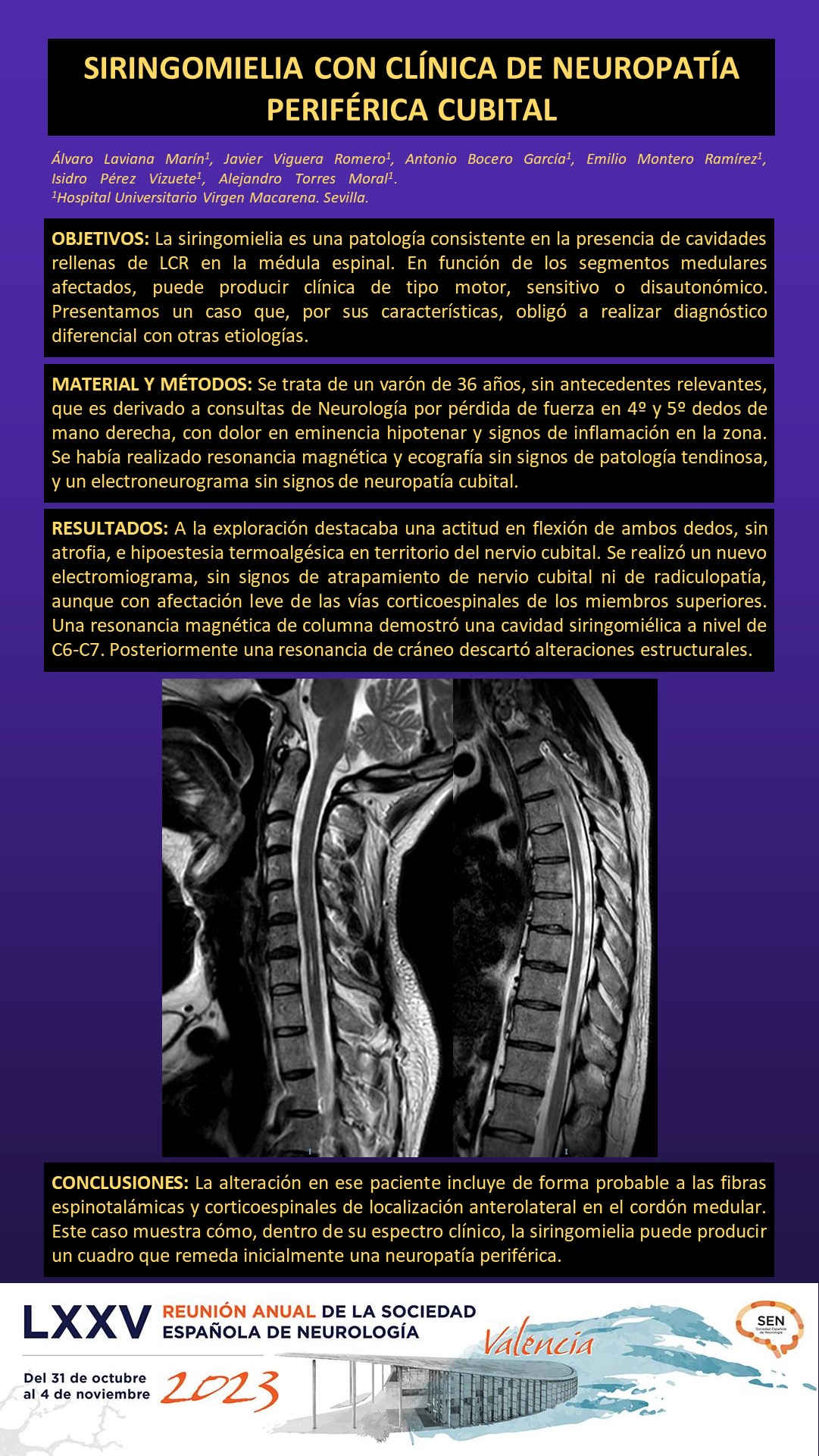 Siringomielia con clínica de neuropatía periférica cubital