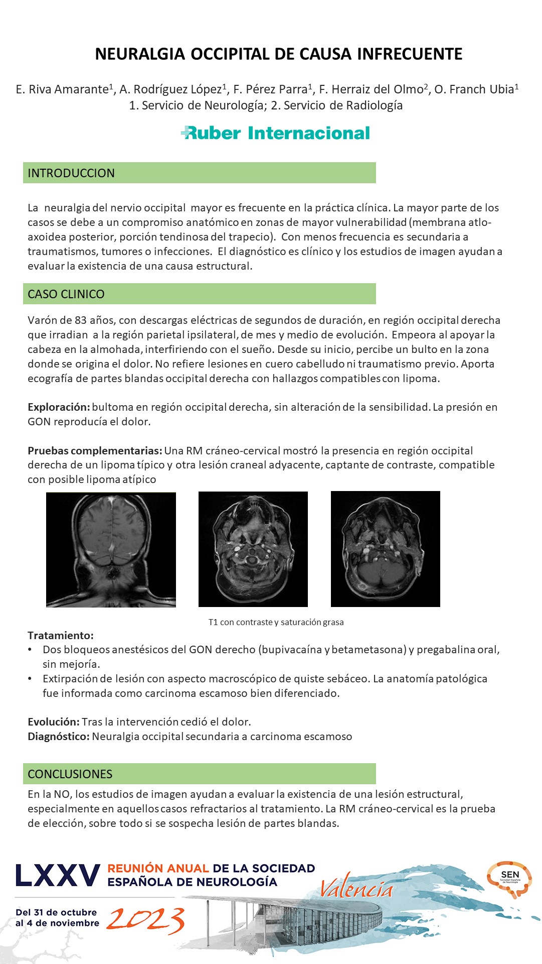 Neuralgia occipital de causa infrecuente 