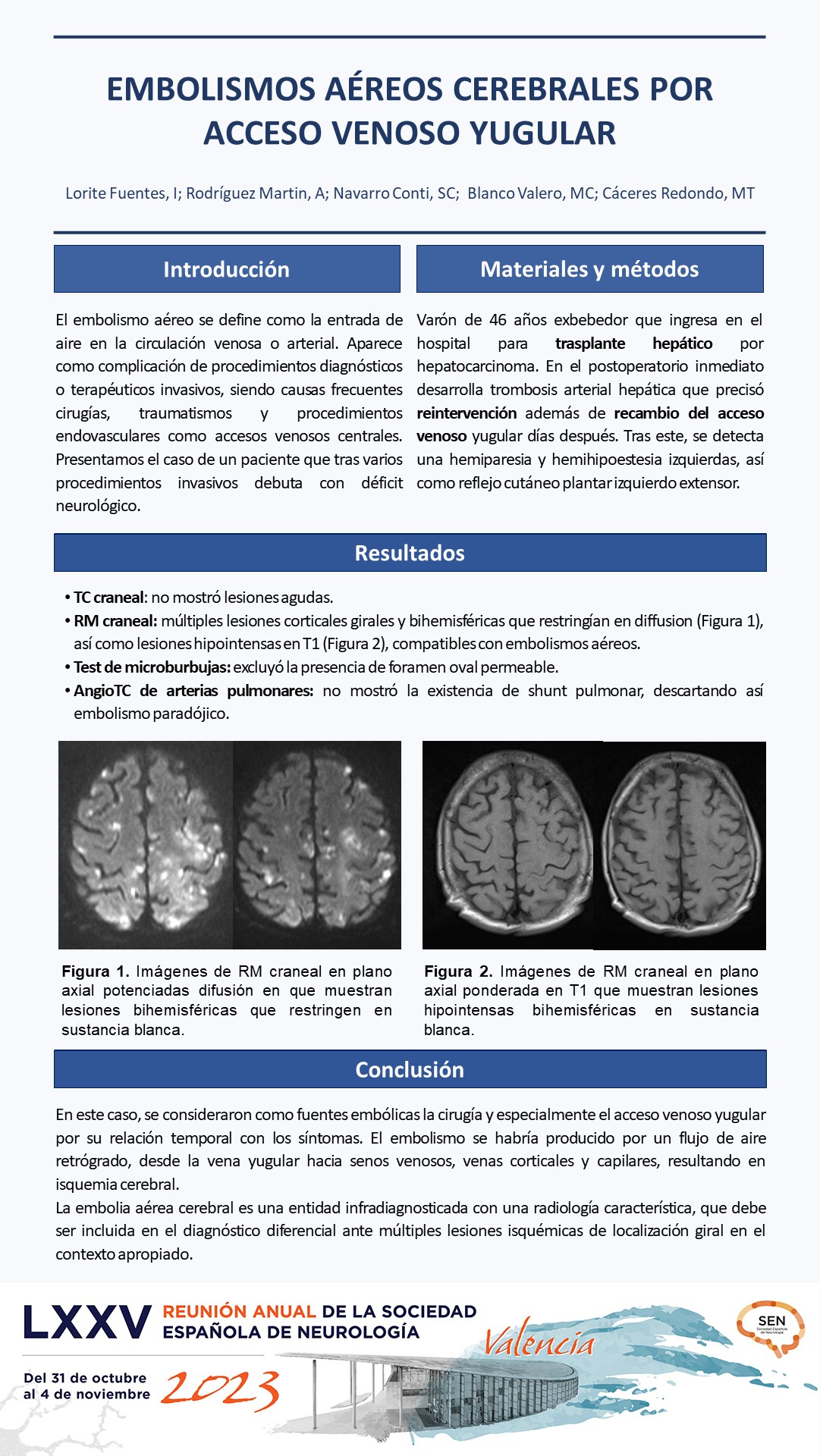 Embolismos aéreos cerebrales por acceso venoso yugular
