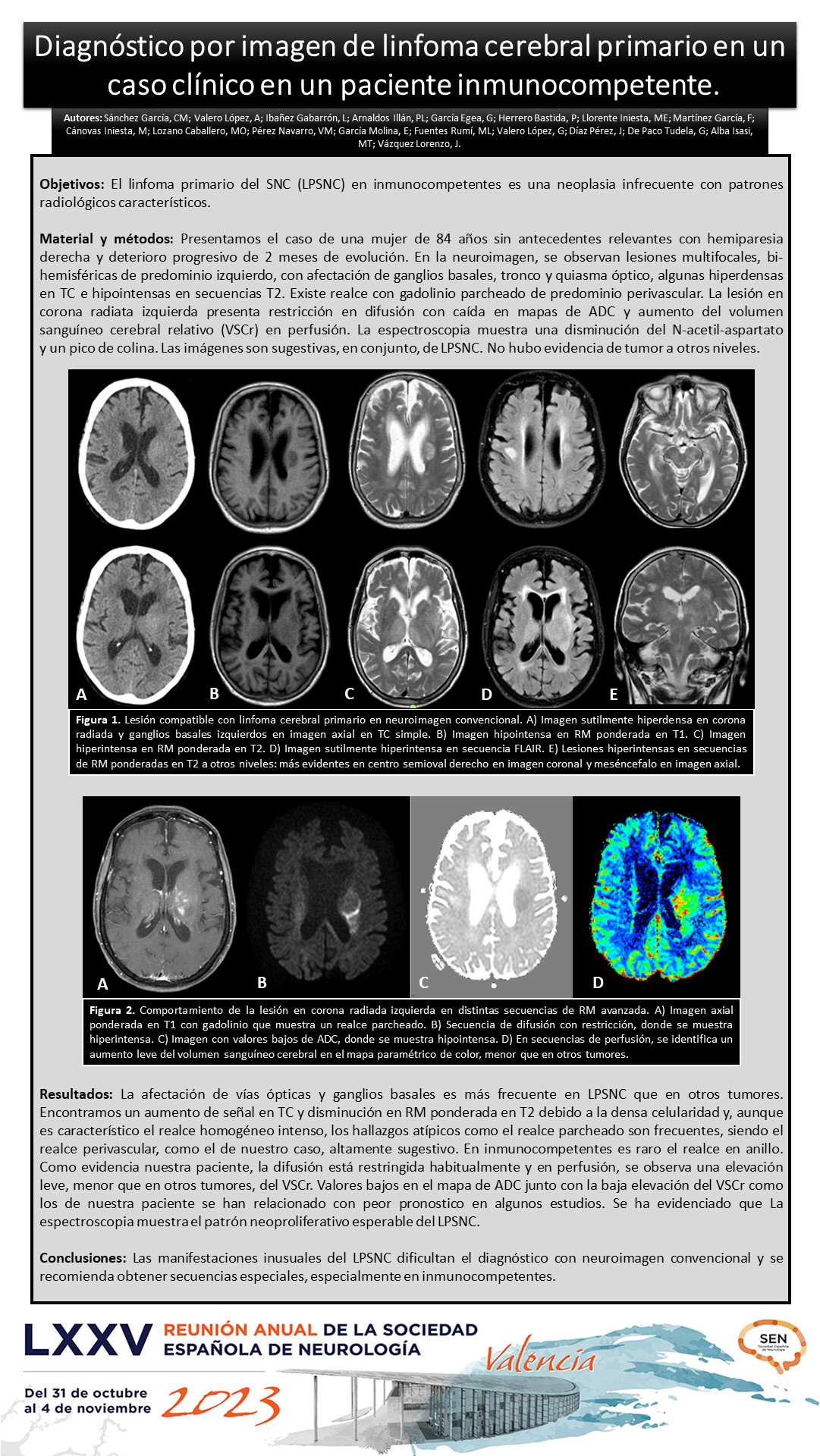 Diagnóstico por imagen de linfoma cerebral primario en un caso clínico en paciente inmunocompetente. 