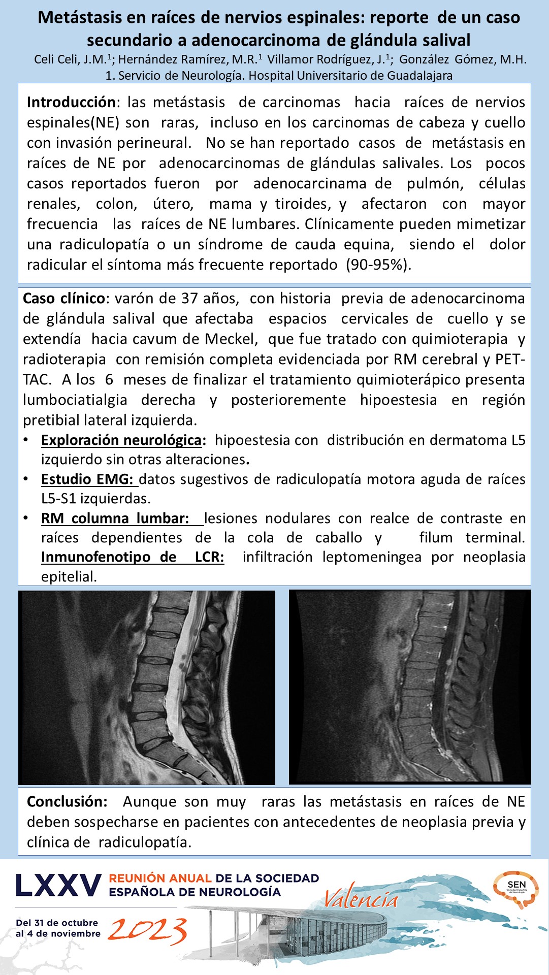 Metástasis en raíces de nervios espinales: reporte  de un caso secundario a adenocarcinoma de glándula salival 