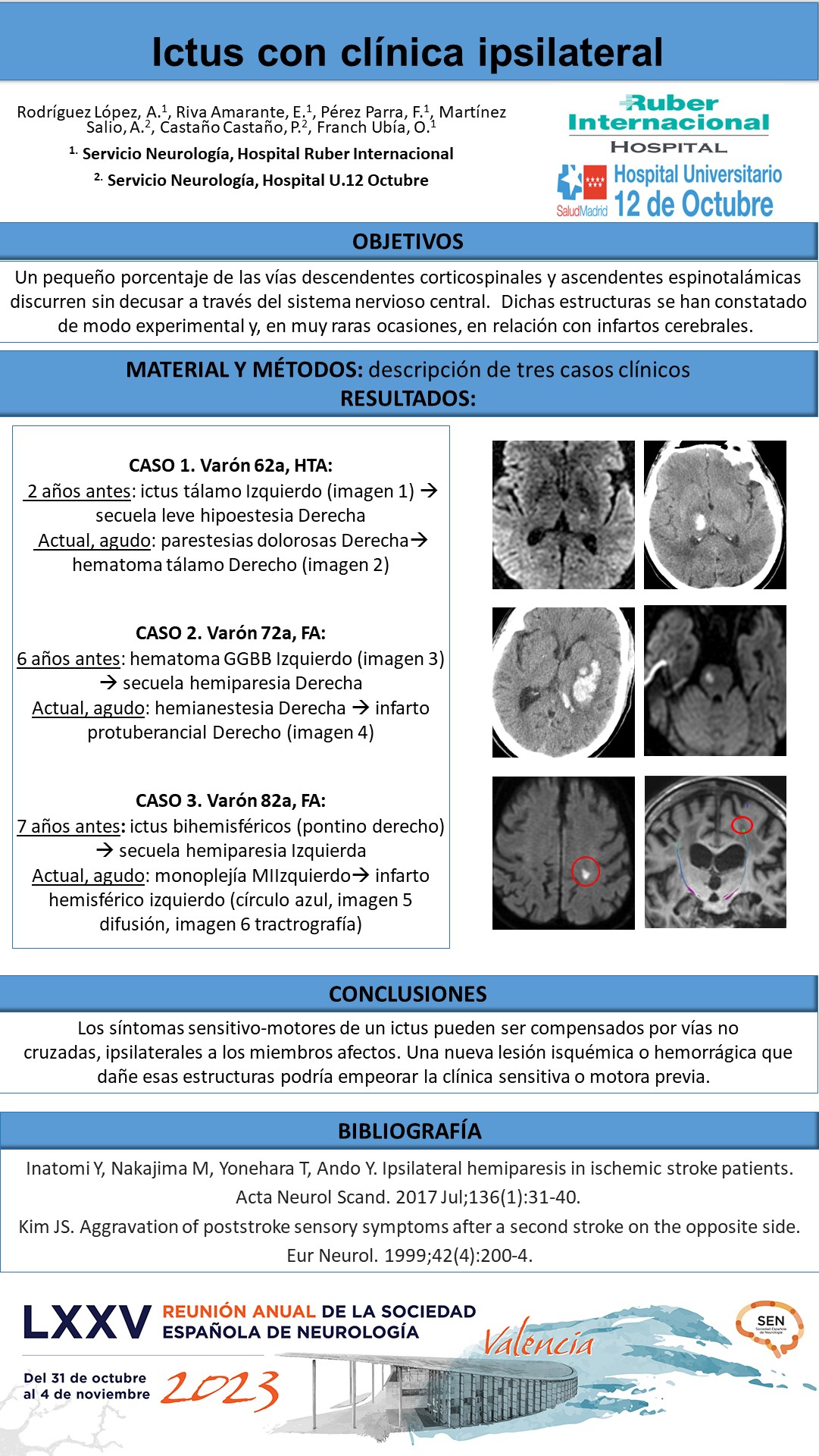 Ictus con clínica ipsilateral 