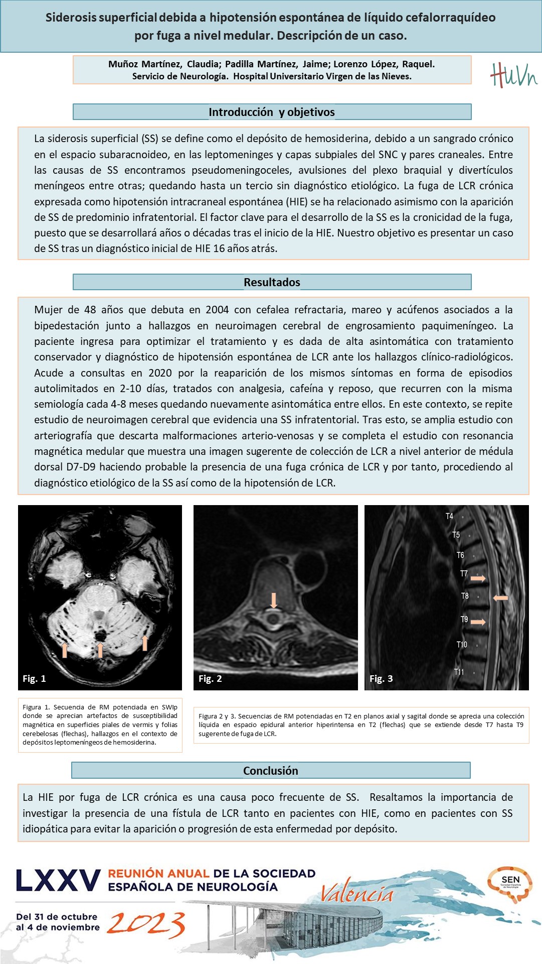 Siderosis superficial debida a hipotensión espontánea de líquido cefalorraquídeo por fuga de a nivel medular. Descripción de un caso.