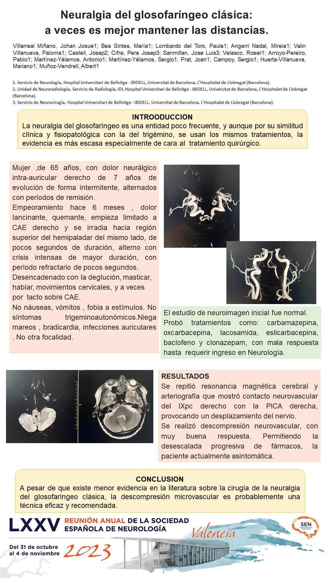 Neuralgia del glosofaríngeo clásica: a veces es mejor mantener las distancias.