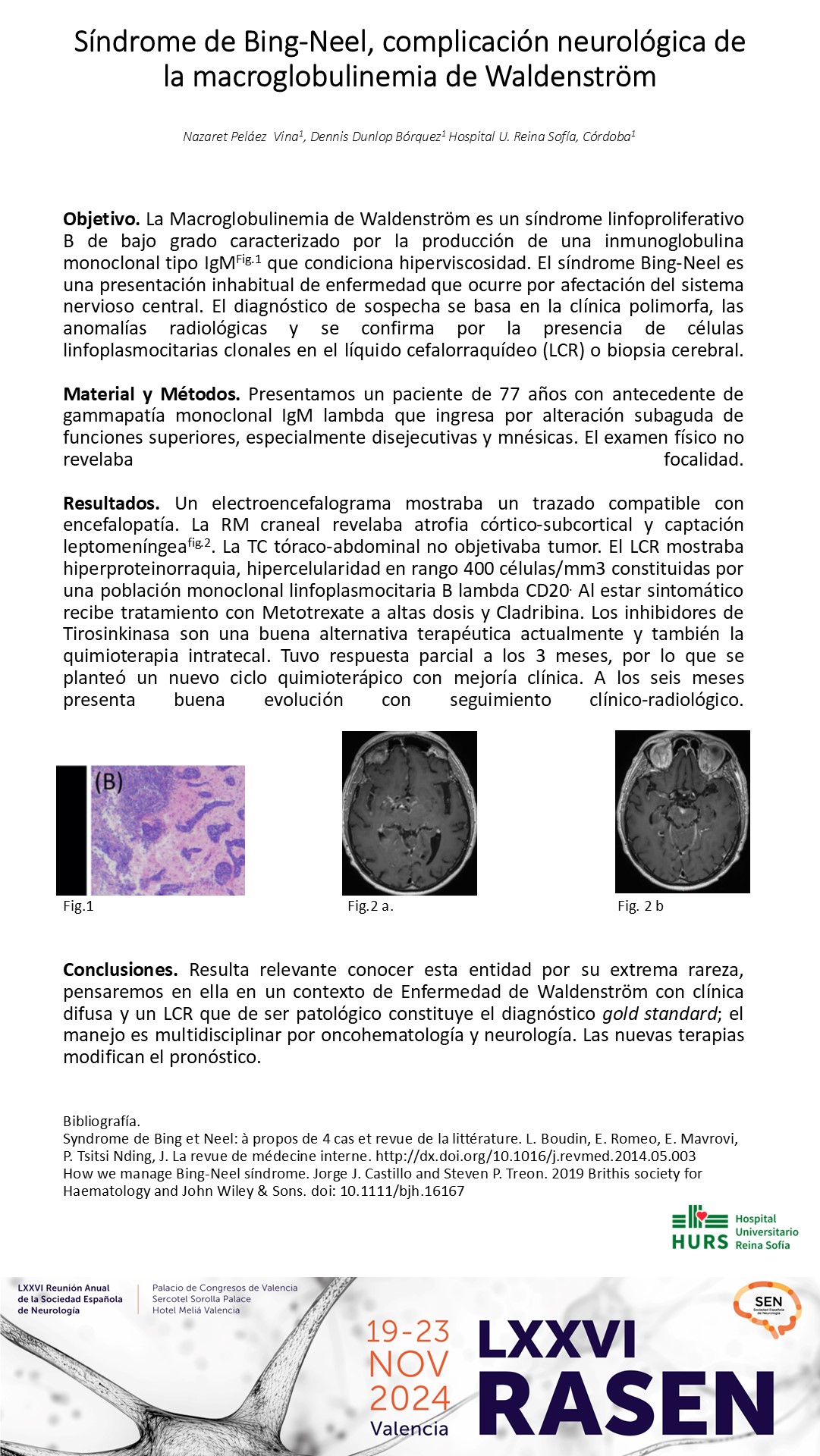 Síndrome de Bing-Neel, complicación neurológica de la macroglobulinemia de Waldenström 