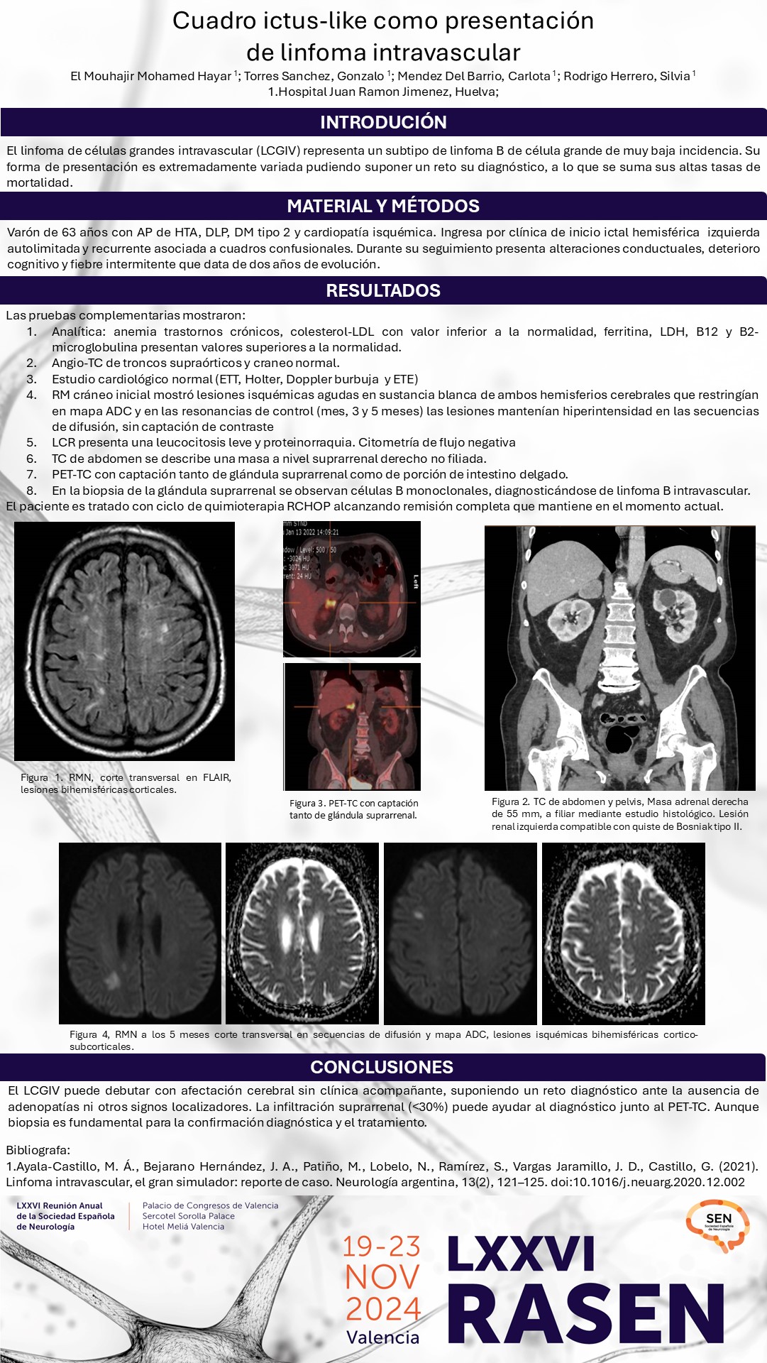 Cuadro ictus-like como presentación de linfoma intravascular