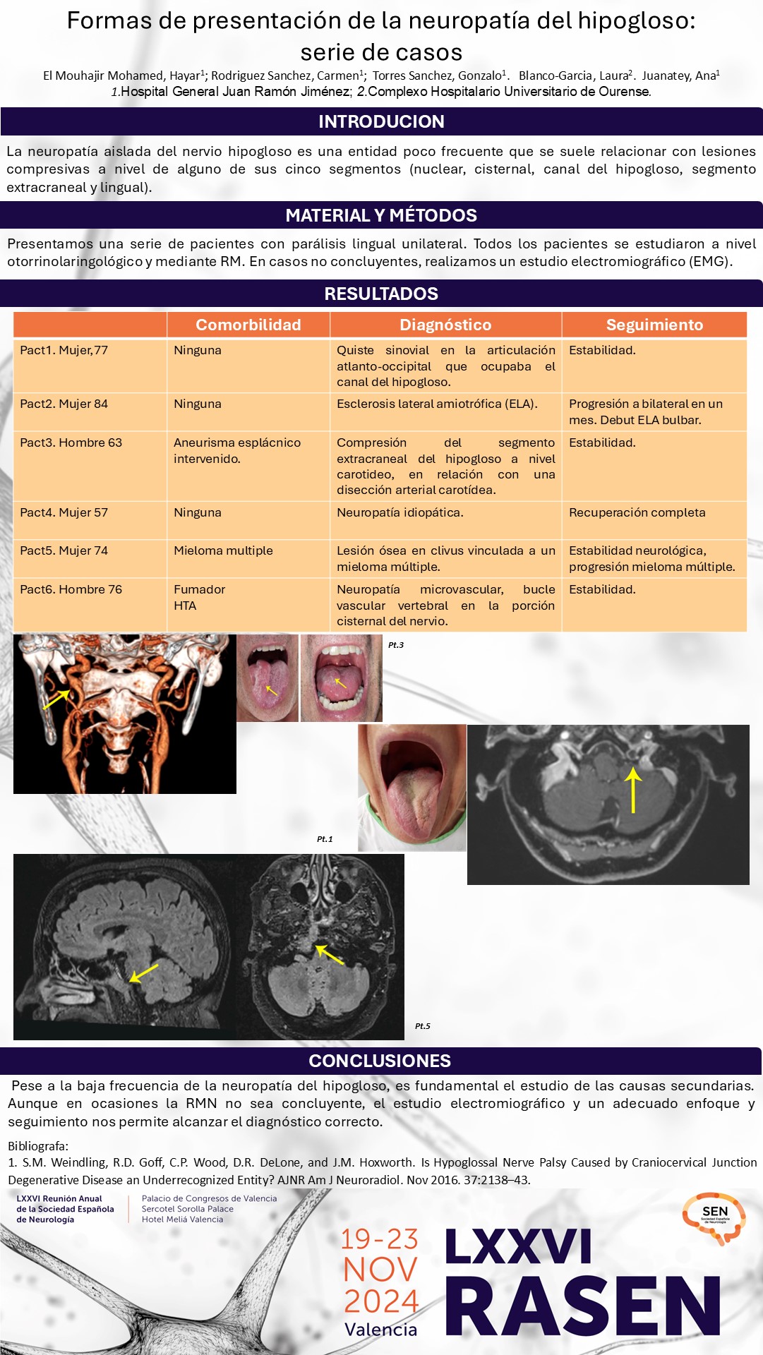 Formas de presentación de la neuropatía del hipogloso: serie de casos