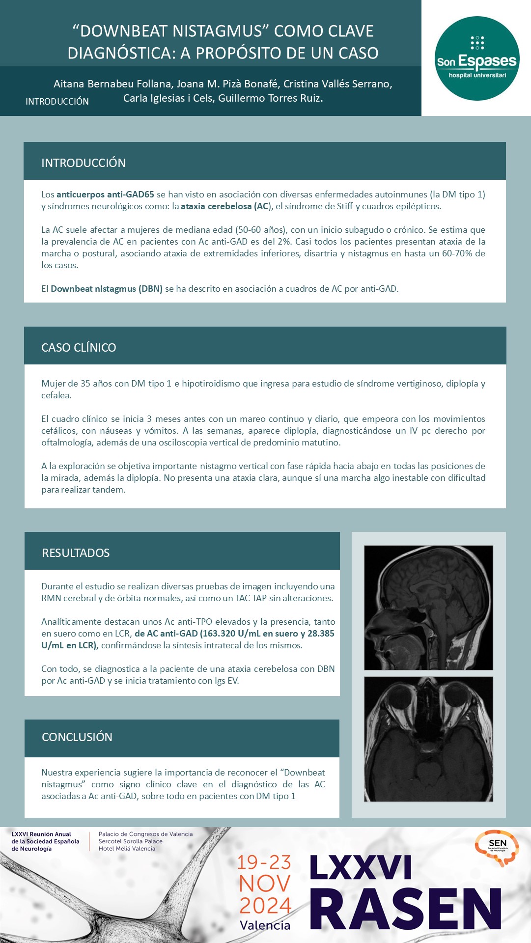 “Downbeat nystagmus” como clave diagnóstica: a propósito de un caso