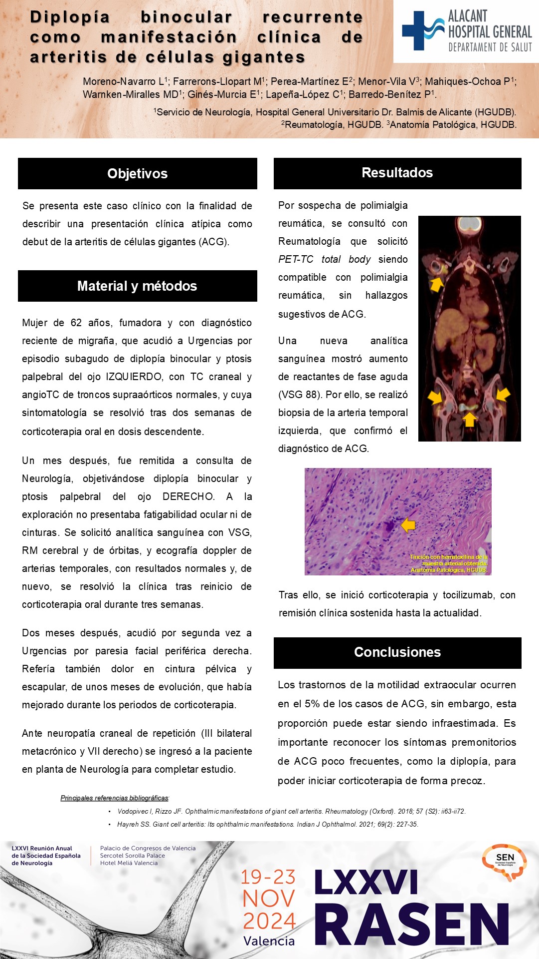 Diplopía binocular recurrente como manifestación clínica de arteritis de células gigantes