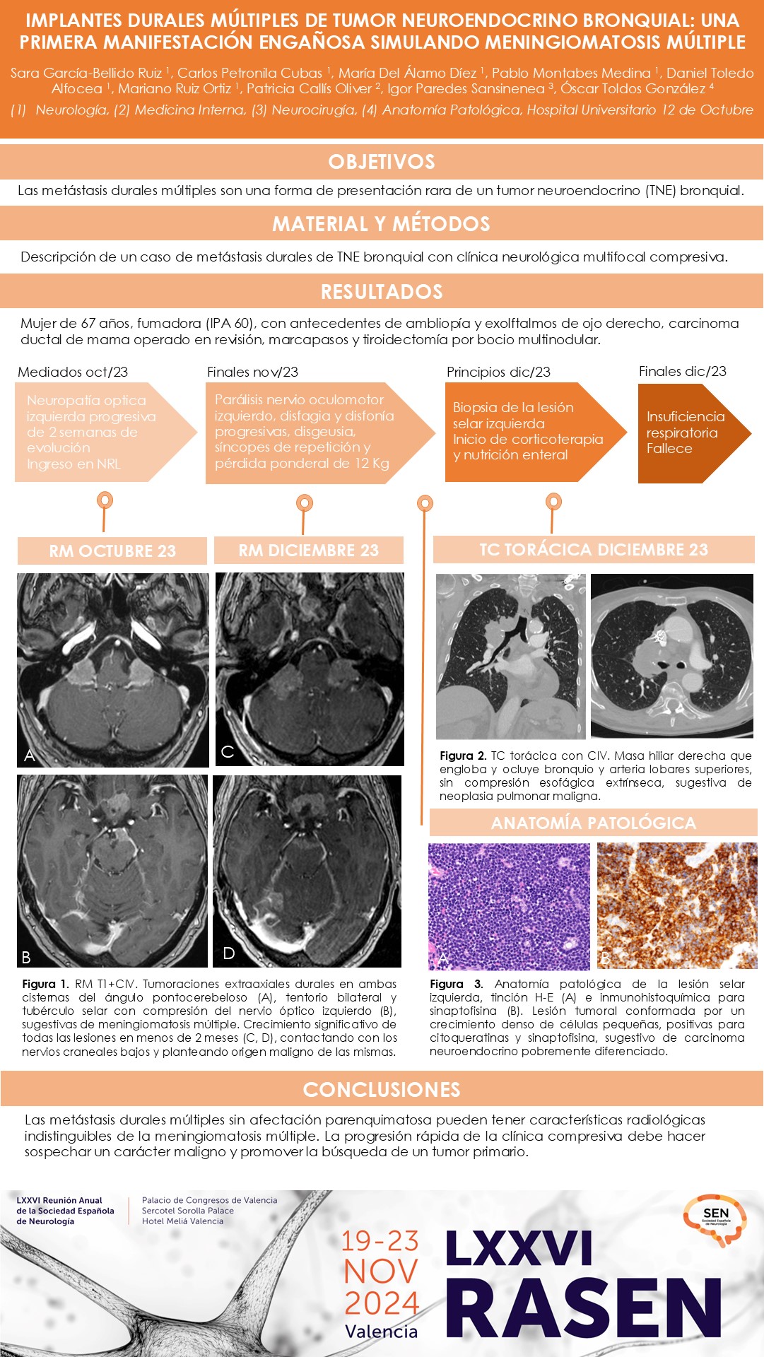 Implantes durales múltiples de tumor neuroendocrino bronquial: una primera manifestación engañosa simulando meningiomatosis múltiple