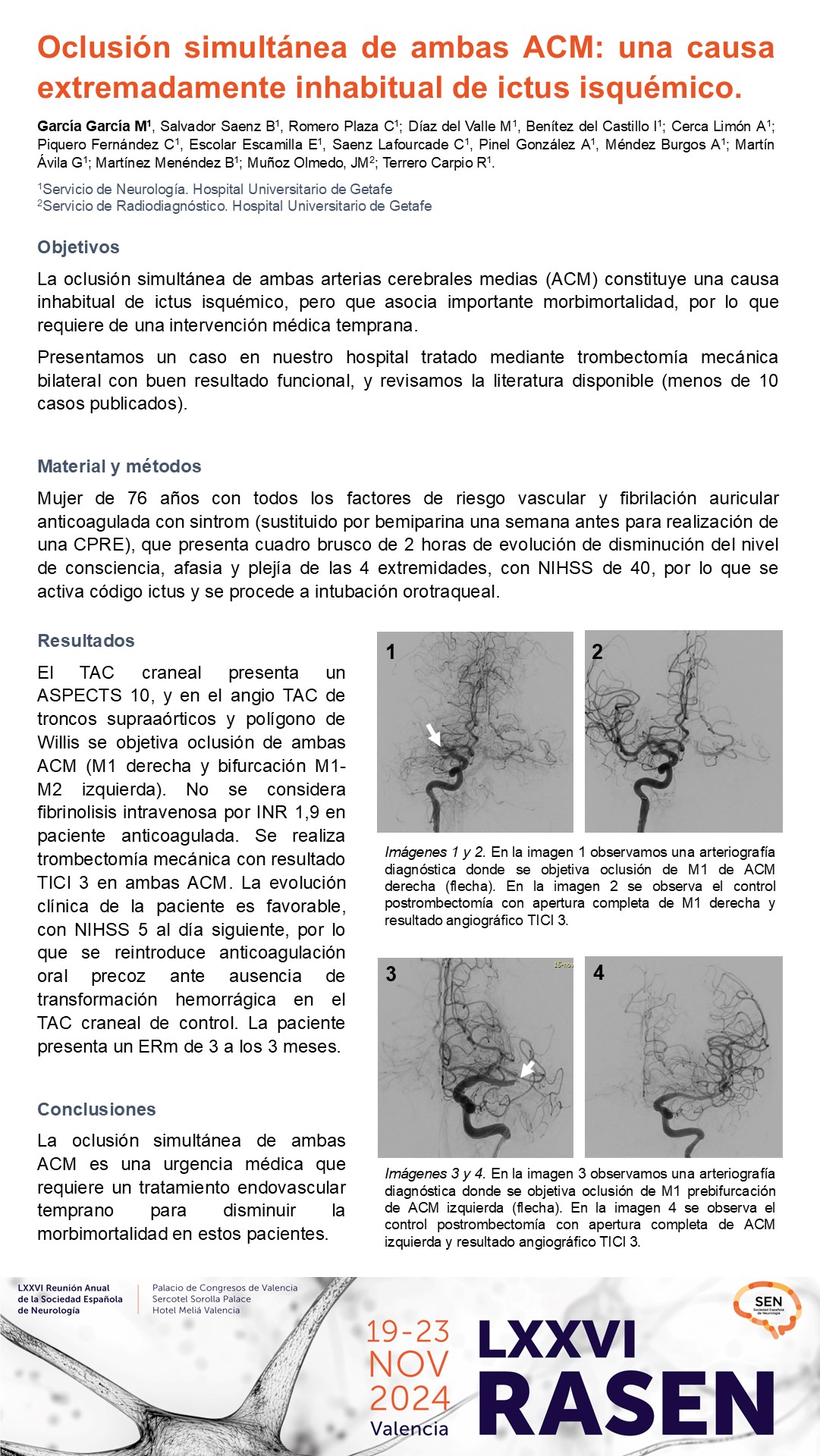 Oclusión simultánea de ambas ACM: una causa extremadamente inhabitual de ictus isquémico