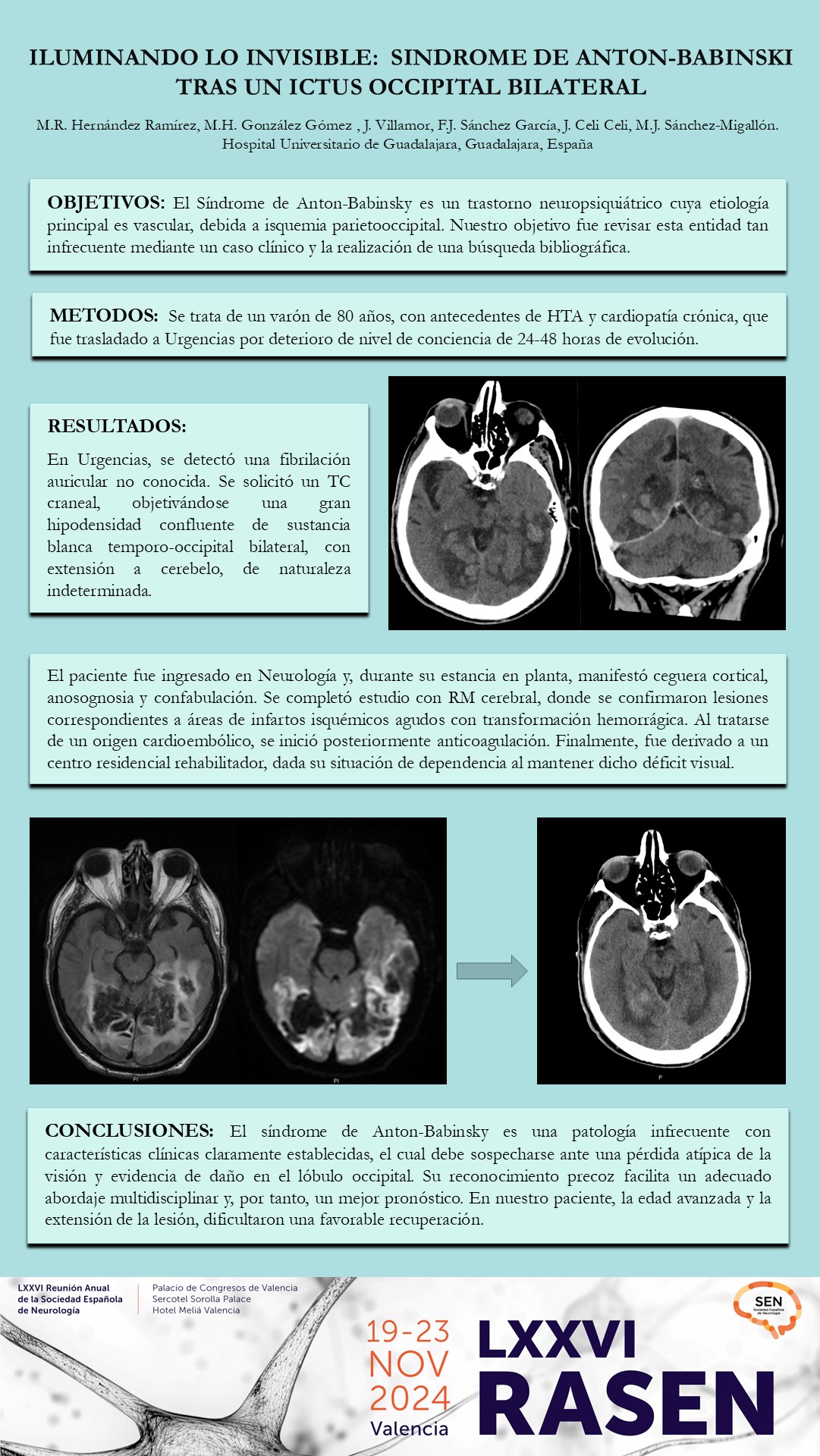 Iluminando lo invisible: síndrome de Anton-Babinski tras un ictus occipital bilateral