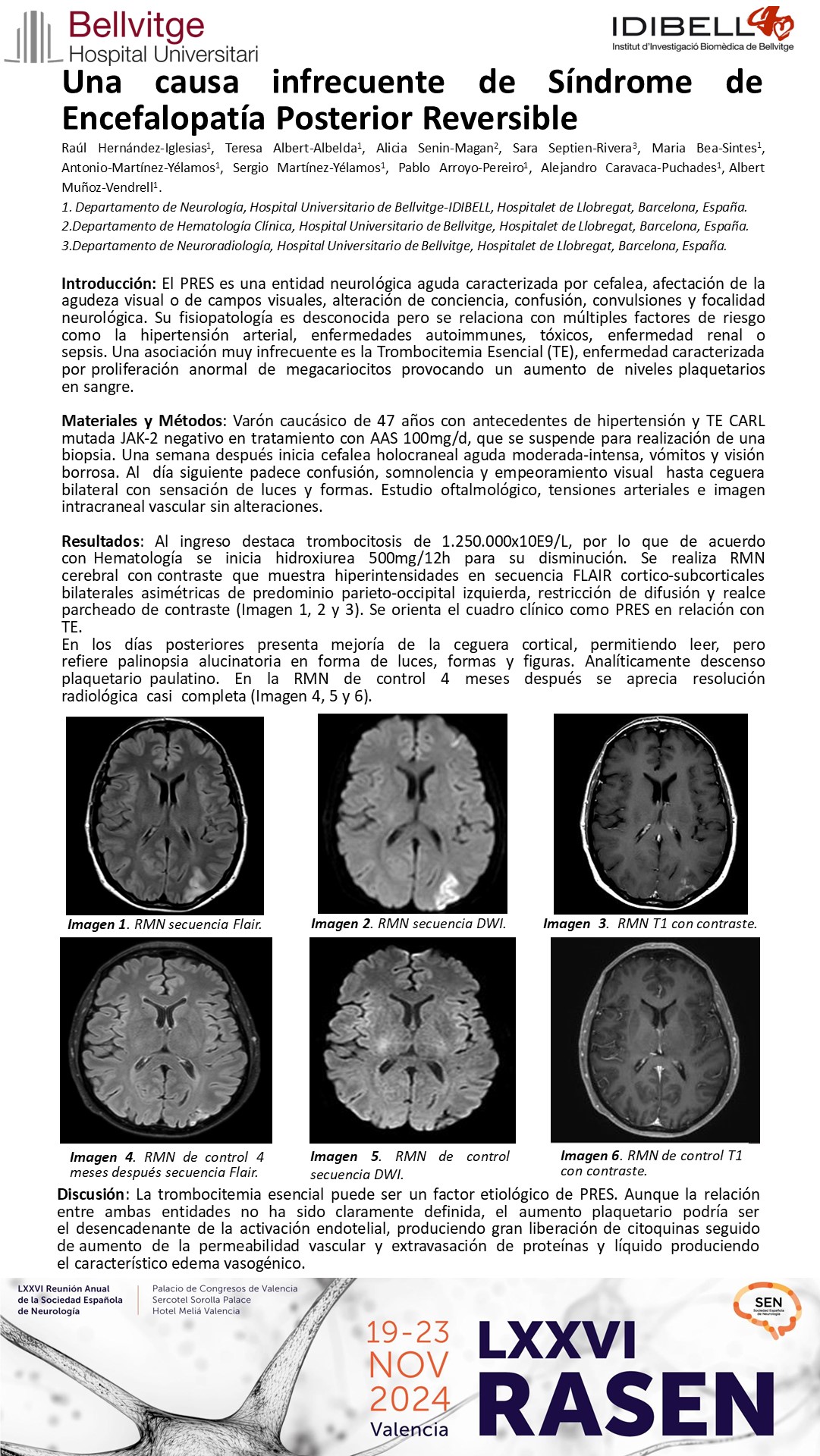 Una causa infrecuente de Síndrome de Encefalopatía Posterior Reversible