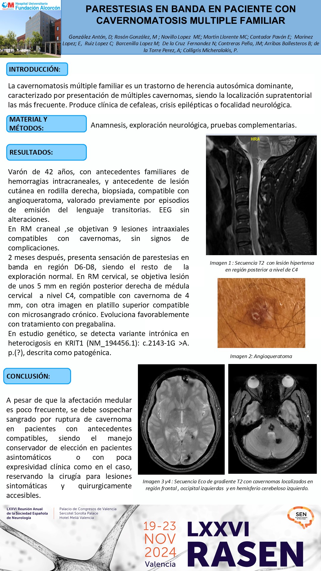 Parestesias en banda en paciente con cavernomatosis múltiple familiar 