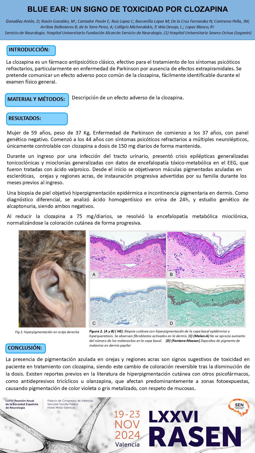 Oreja azul: un signo de toxicidad por clozapina 