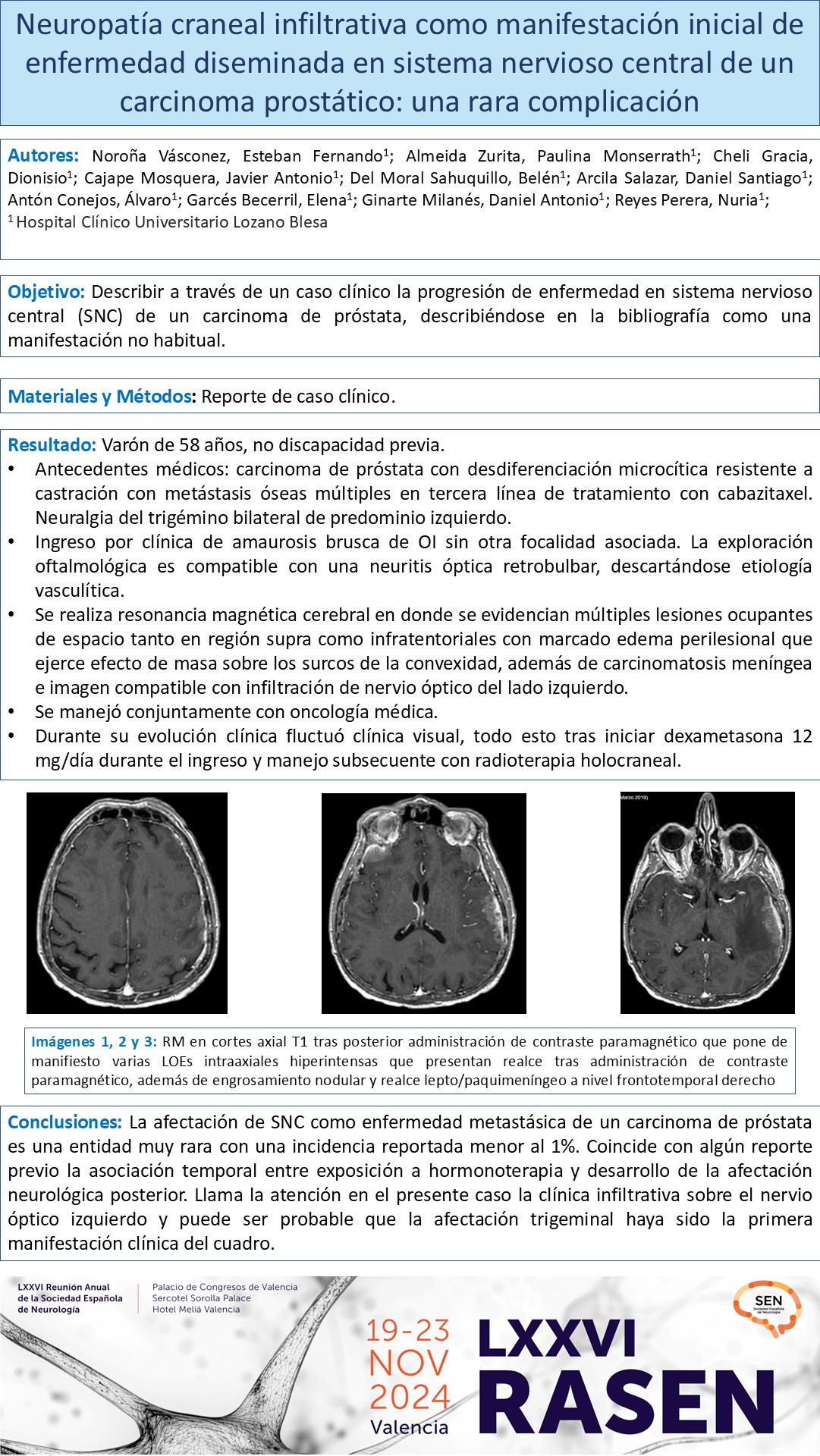 Neuropatía craneal infiltrativa como manifestación inicial de enfermedad diseminada en sistema nervioso central de un carcinoma prostático: una rara complicación